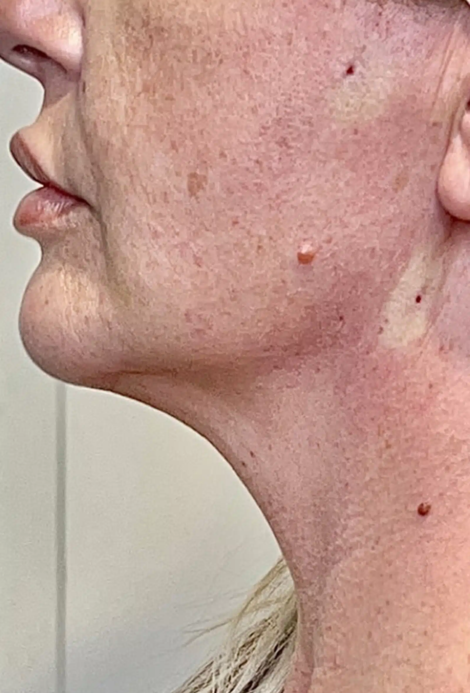 Expect During a Thread Lift Procedure