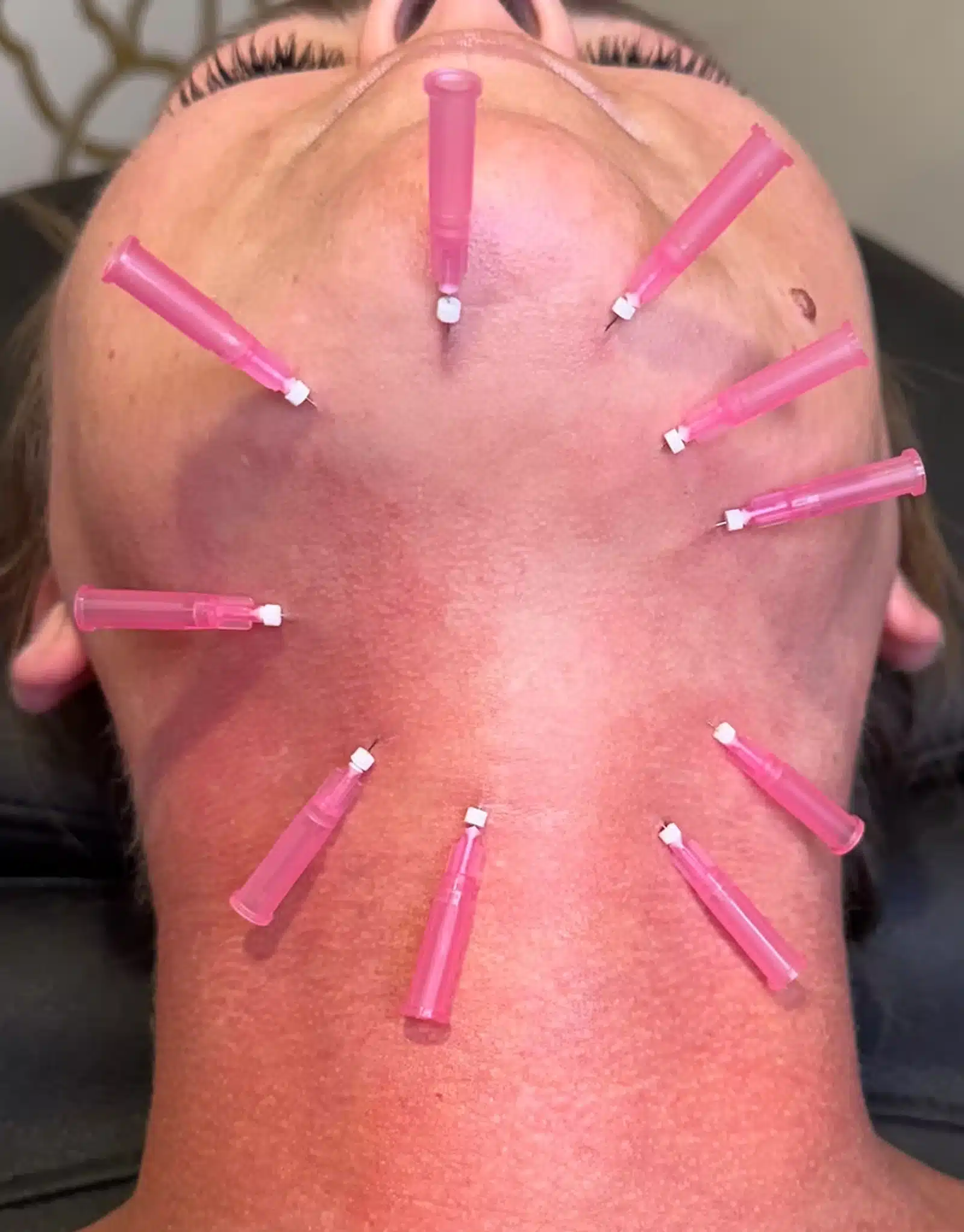 Thread Lift and How Does It Work