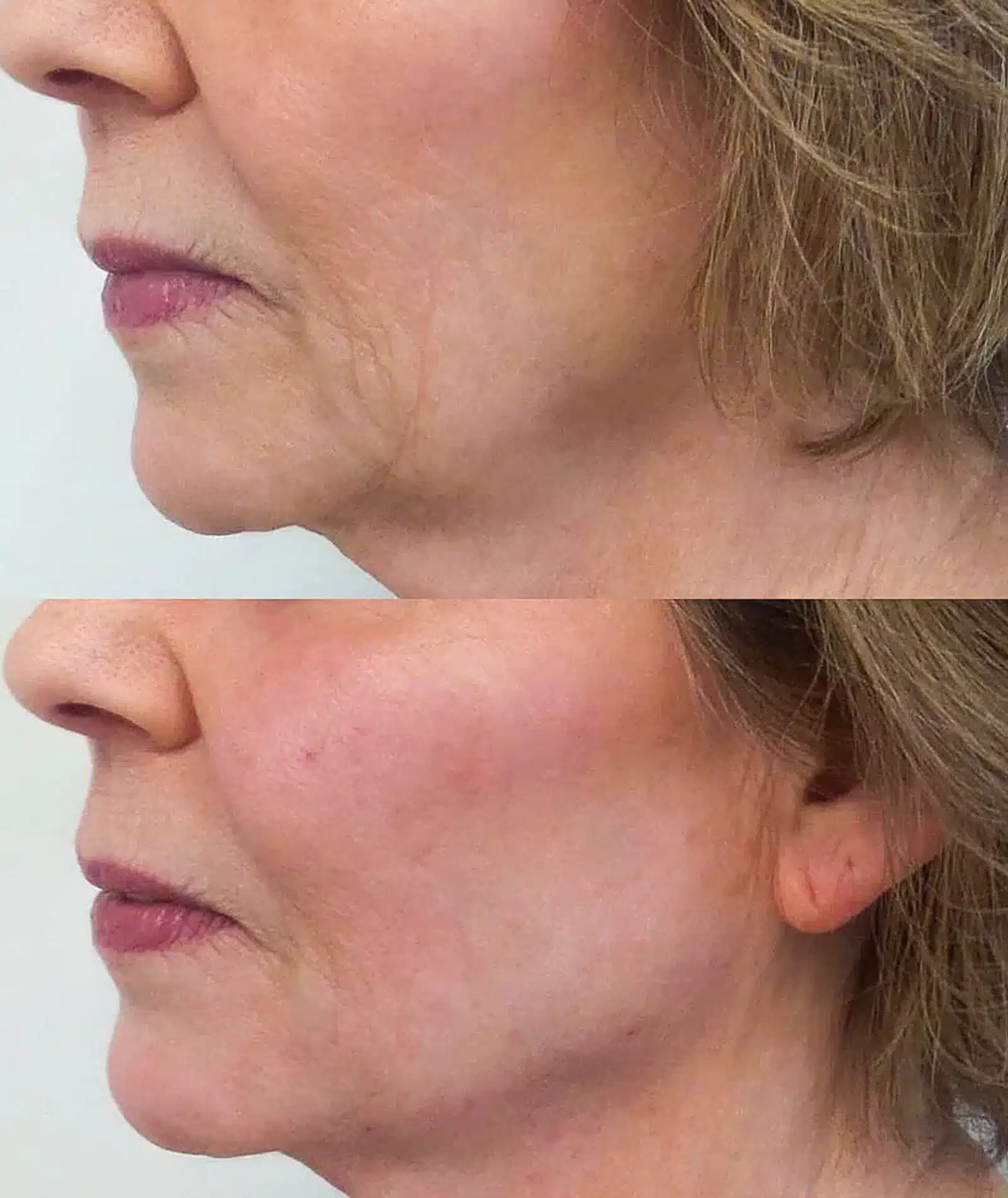 Botox Treatment Winston‑Salem