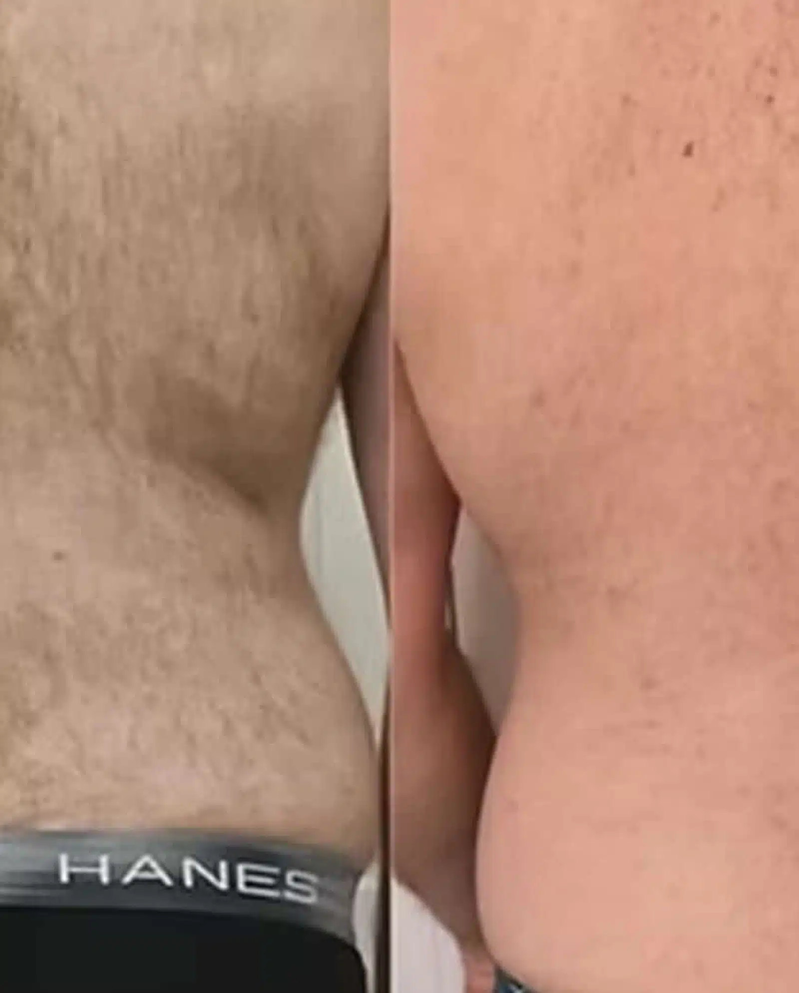 Choosing Professional Laser Treatments