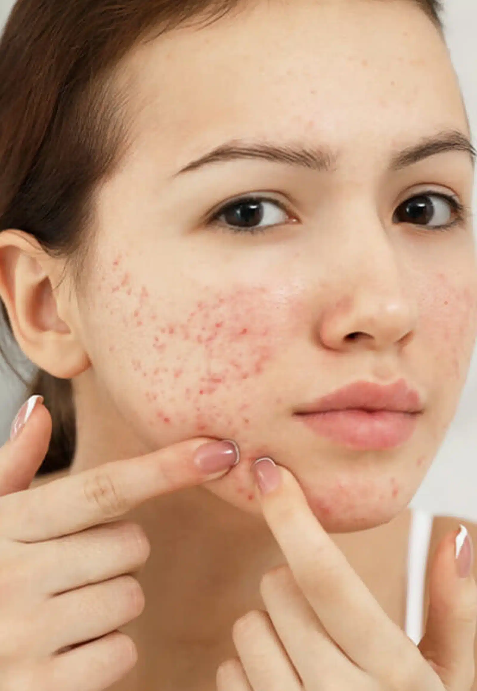 Chemical Peel Appointment
