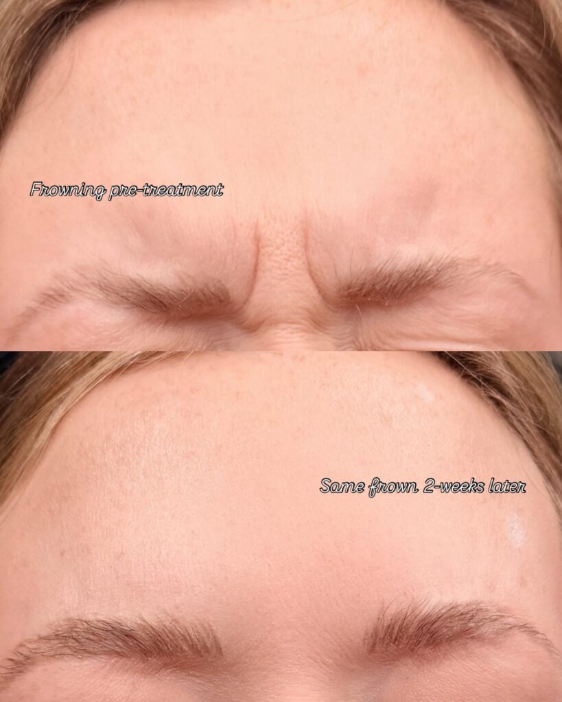 What Happens When You Stop Botox