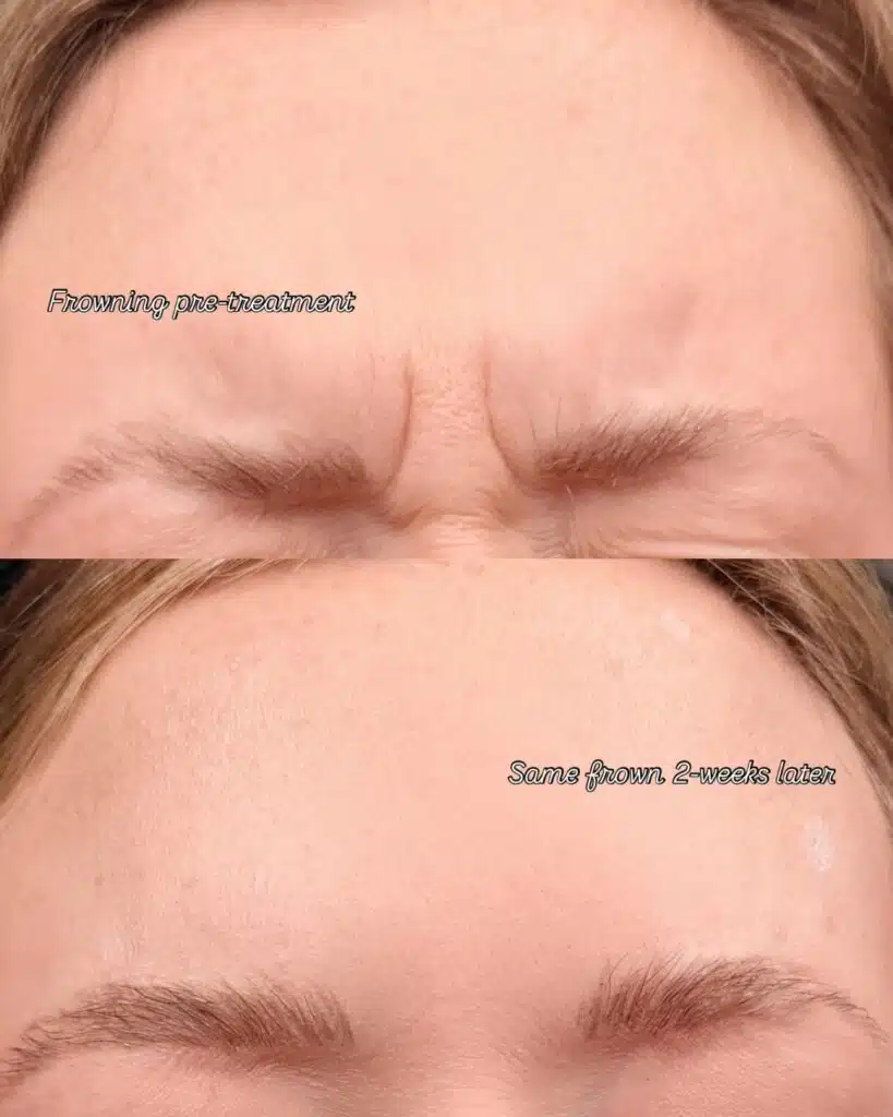 What Happens When You Stop Botox