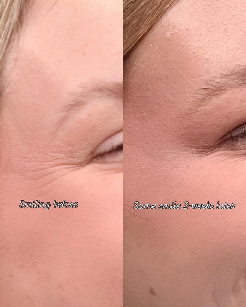 What Happens When You Stop Botox