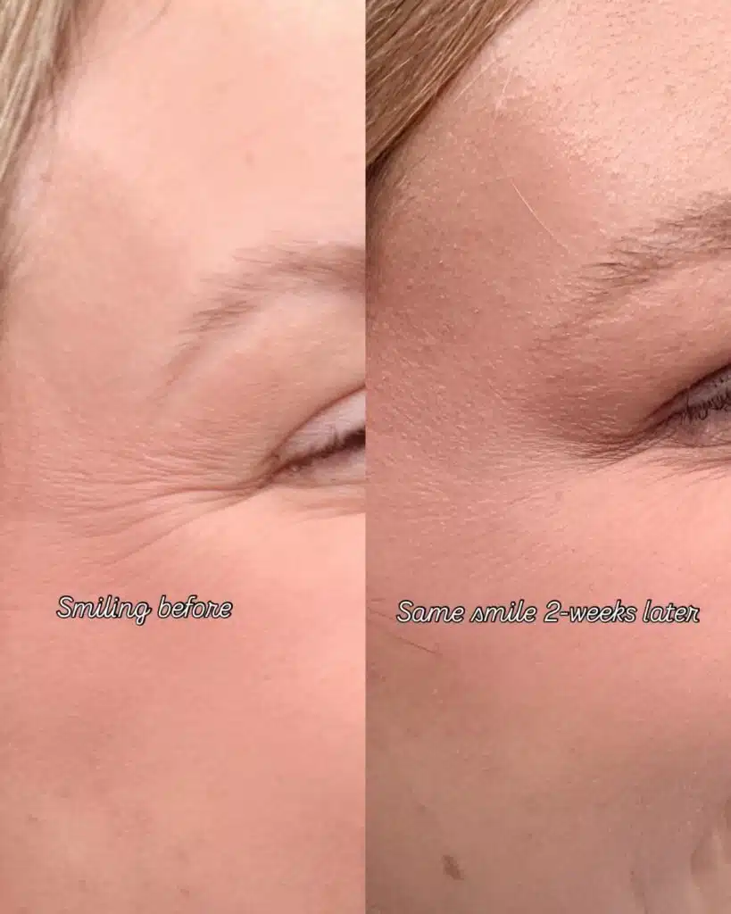 What Happens When You Stop Botox