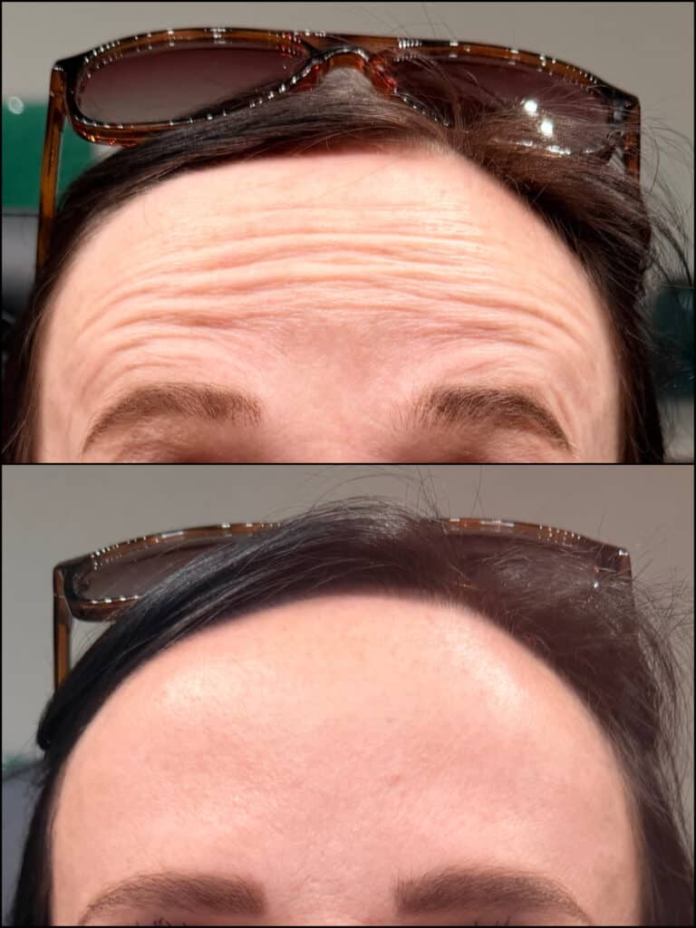 Dysport for Wrinkle Reduction