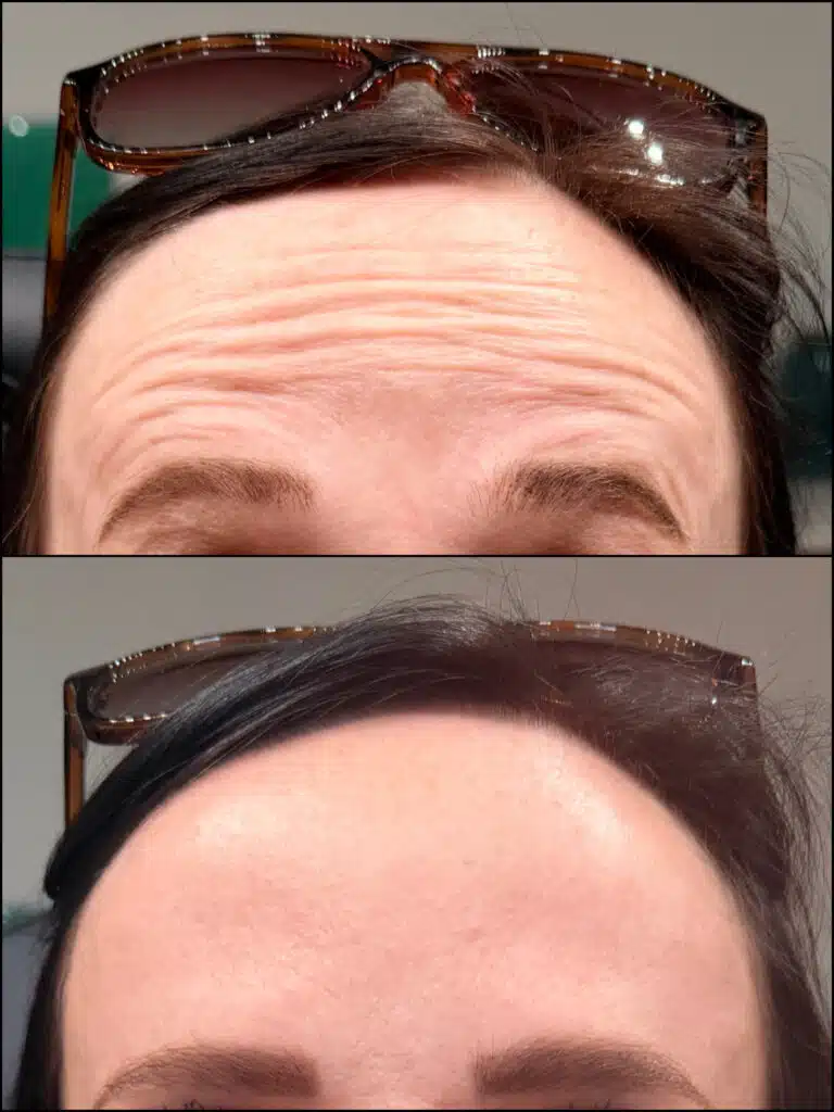Dysport for Wrinkle Reduction