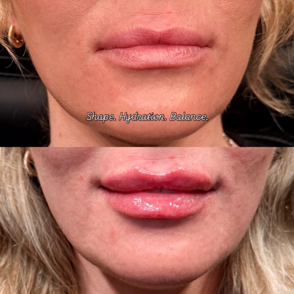 what to avoid after lip fillers