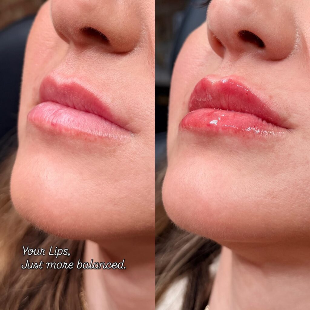 what to avoid after lip fillers