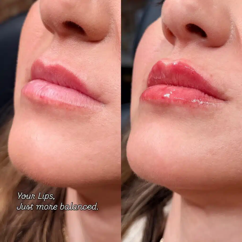 what to avoid after lip fillers