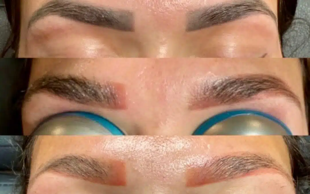 Microblading Removal Explained: Laser vs Saline Techniques for Safe Brow Correction