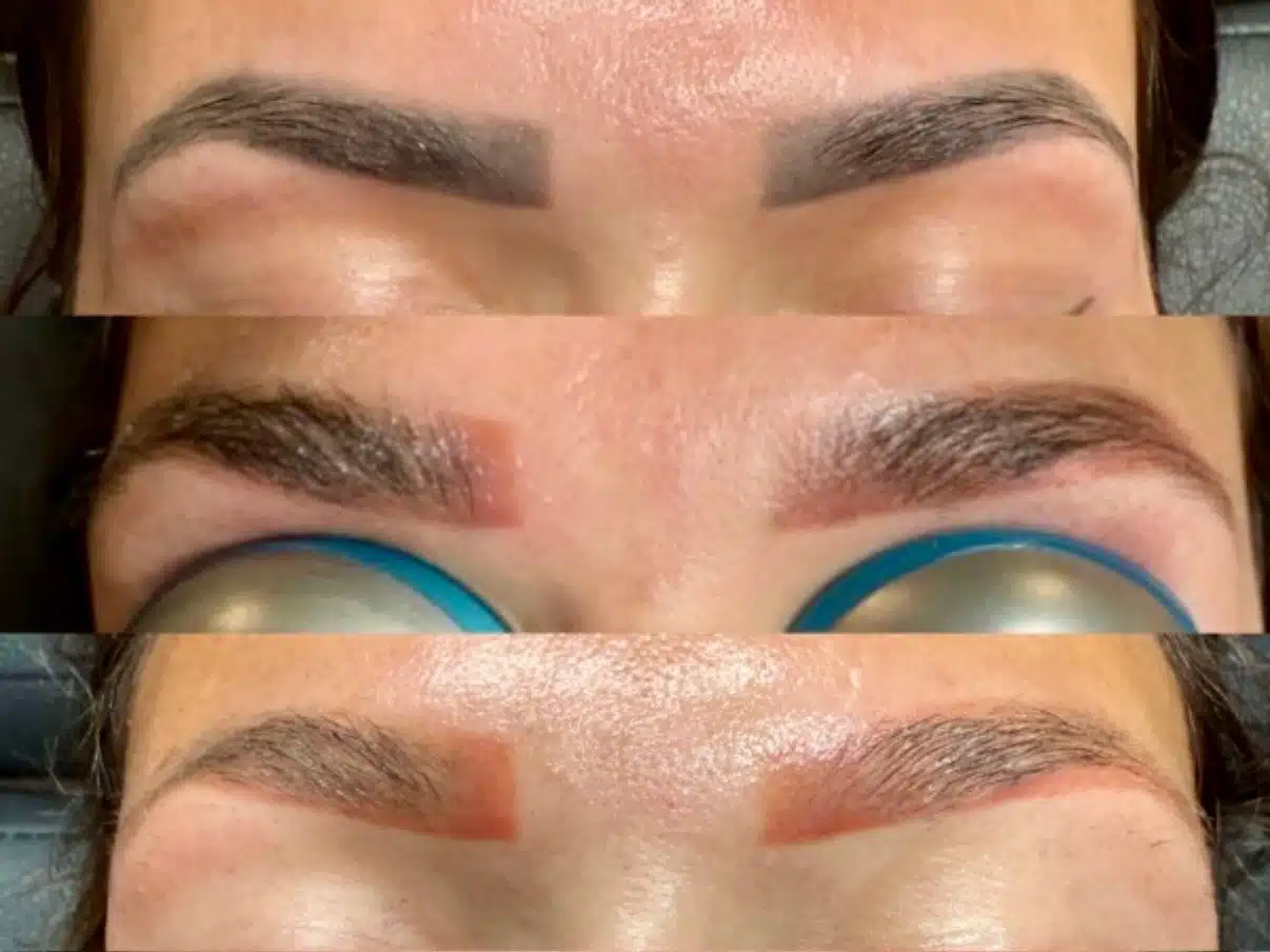Microblading Removal Explained