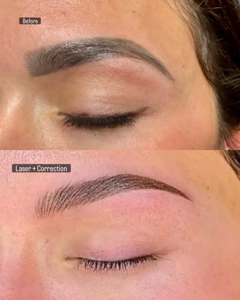 Microblading Removal Explained