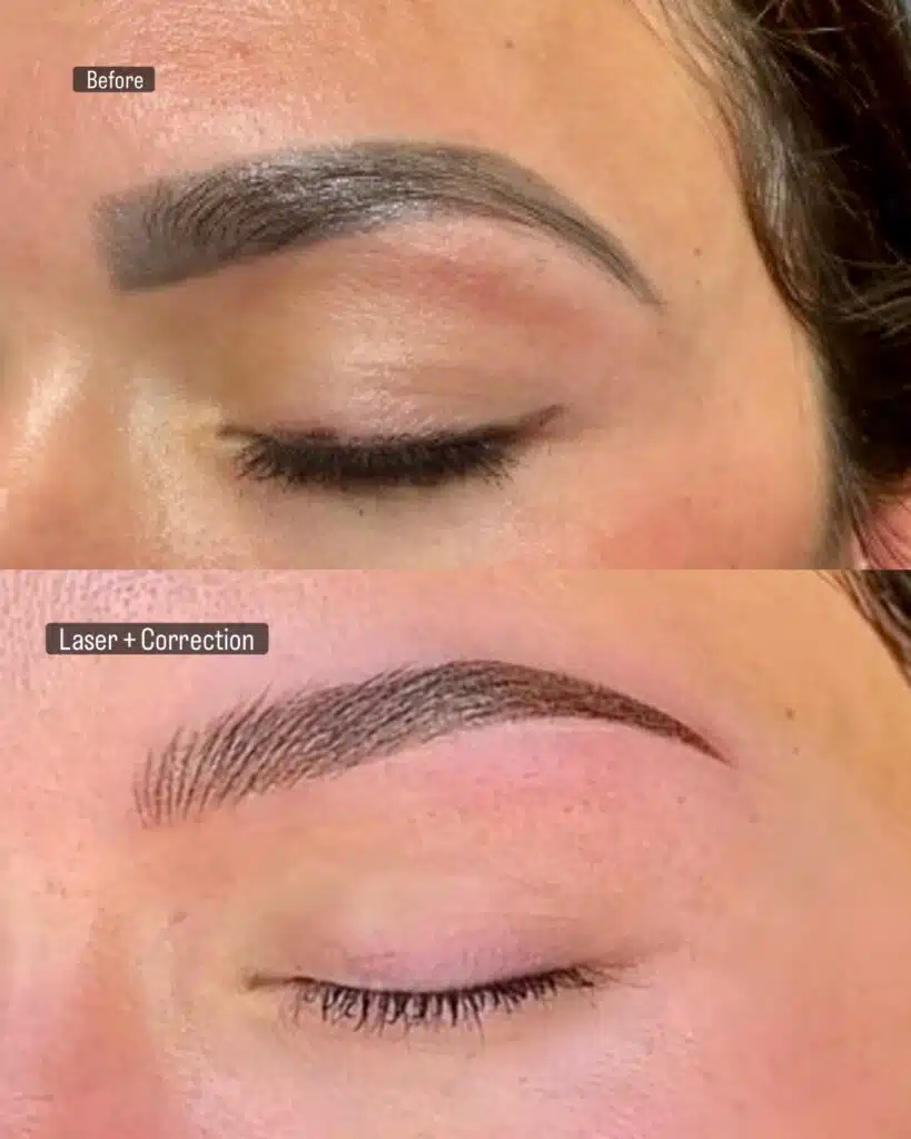 Microblading Removal Explained