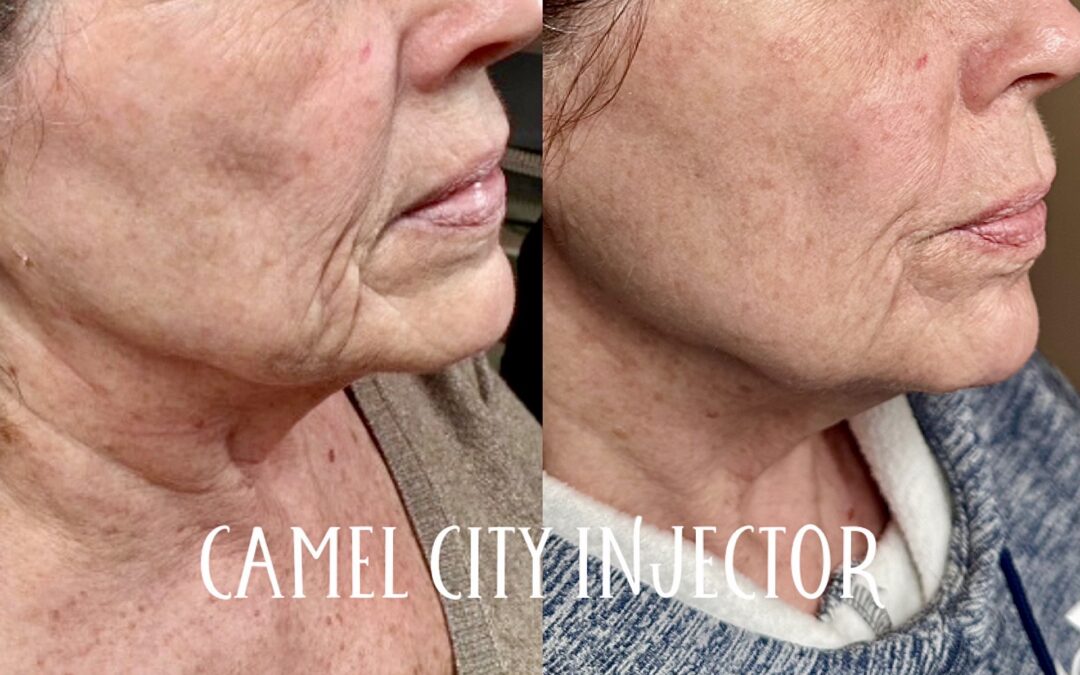 Is RF Microneedling Safe for All Skin Types? What You Need to Know