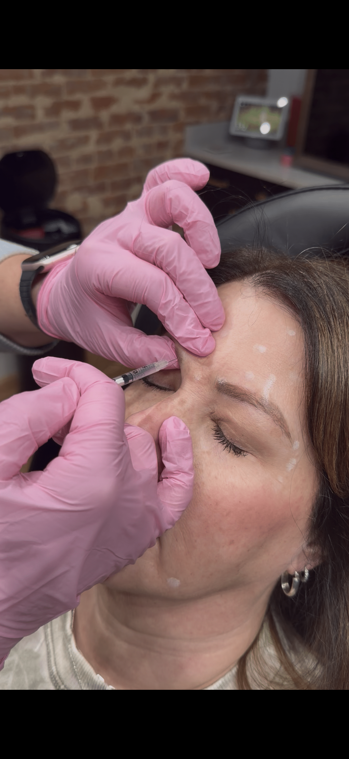Dysport VS Botox For Forehead Lines