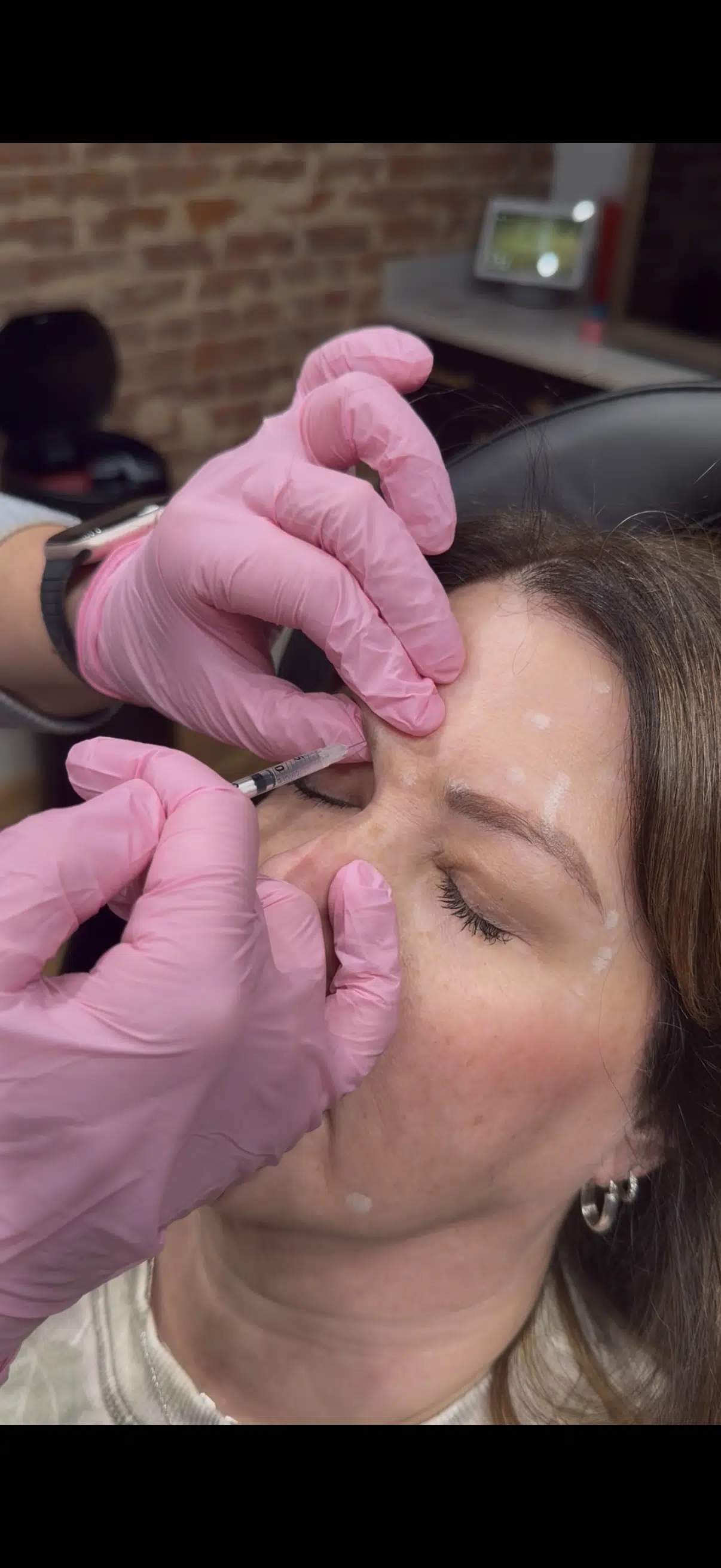 Dysport VS Botox For Forehead Lines