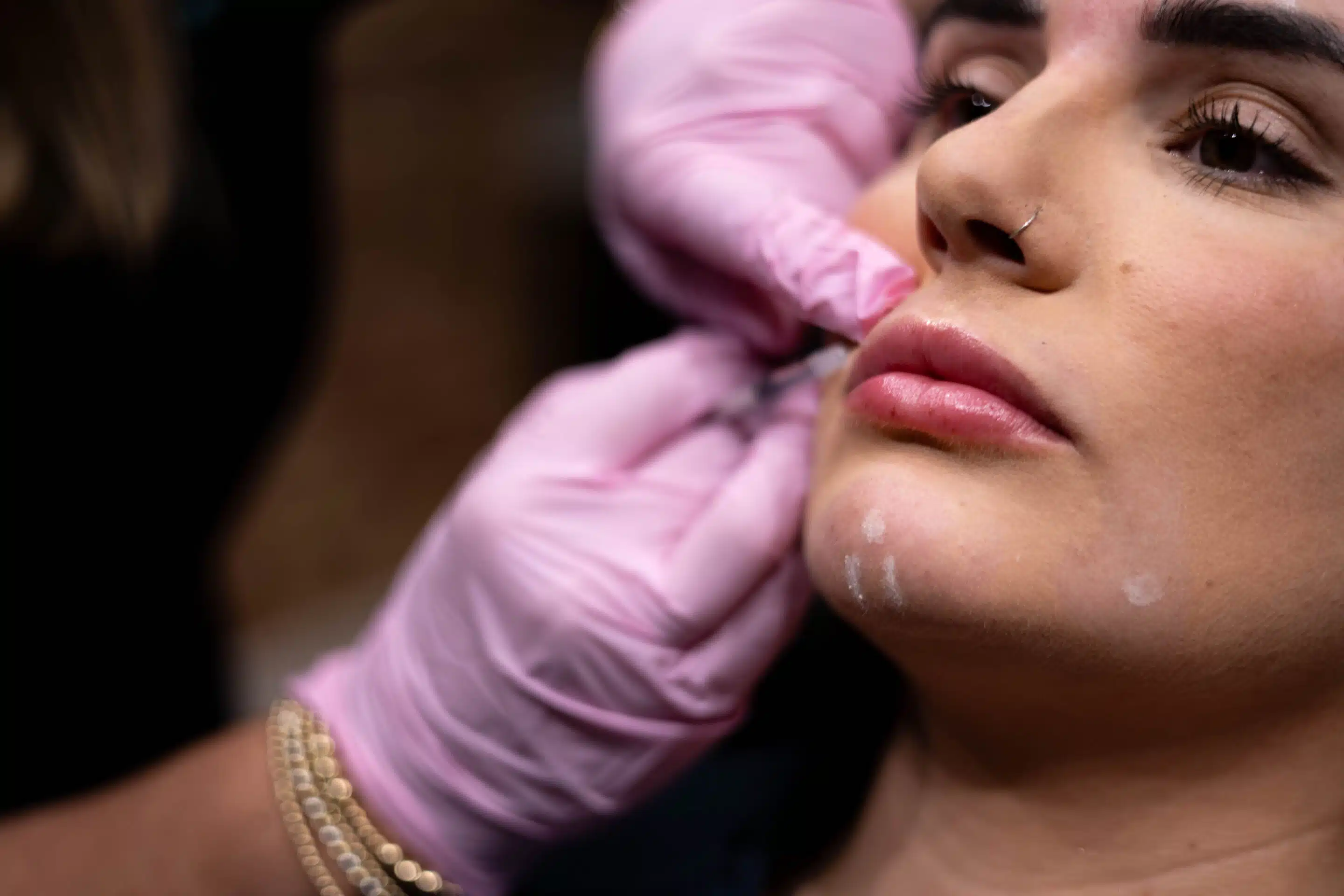 Lip Filler Winston Salem