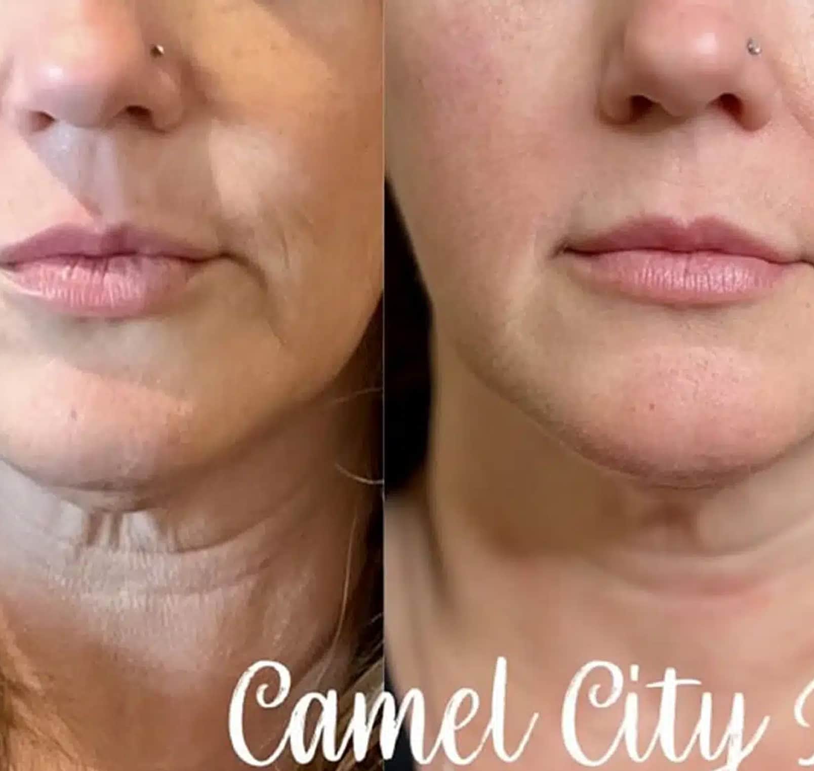 Cheek Fillers Midface Rejuvenation dermal filler designed to redefine