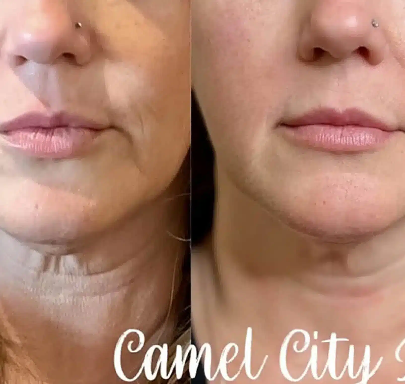 dermal filler designed to redefine