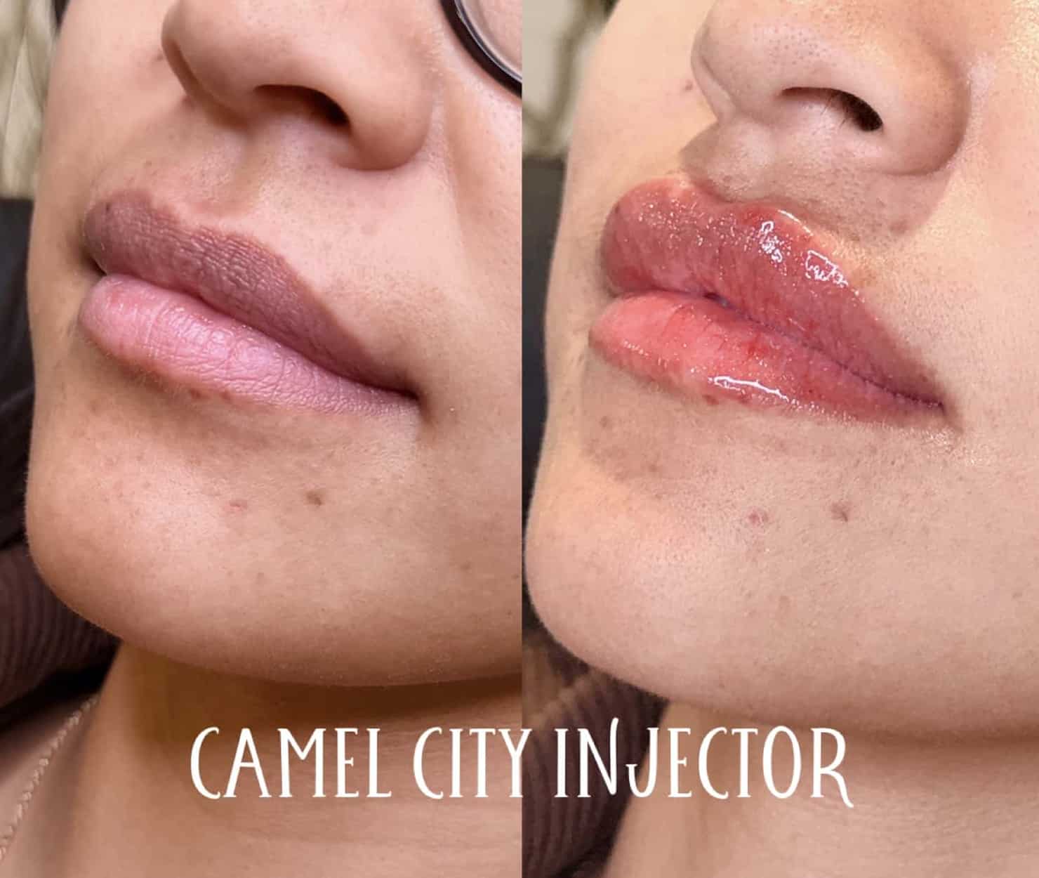 Cheek Fillers facelifts, dermal fillers dermal filler designed to redefine