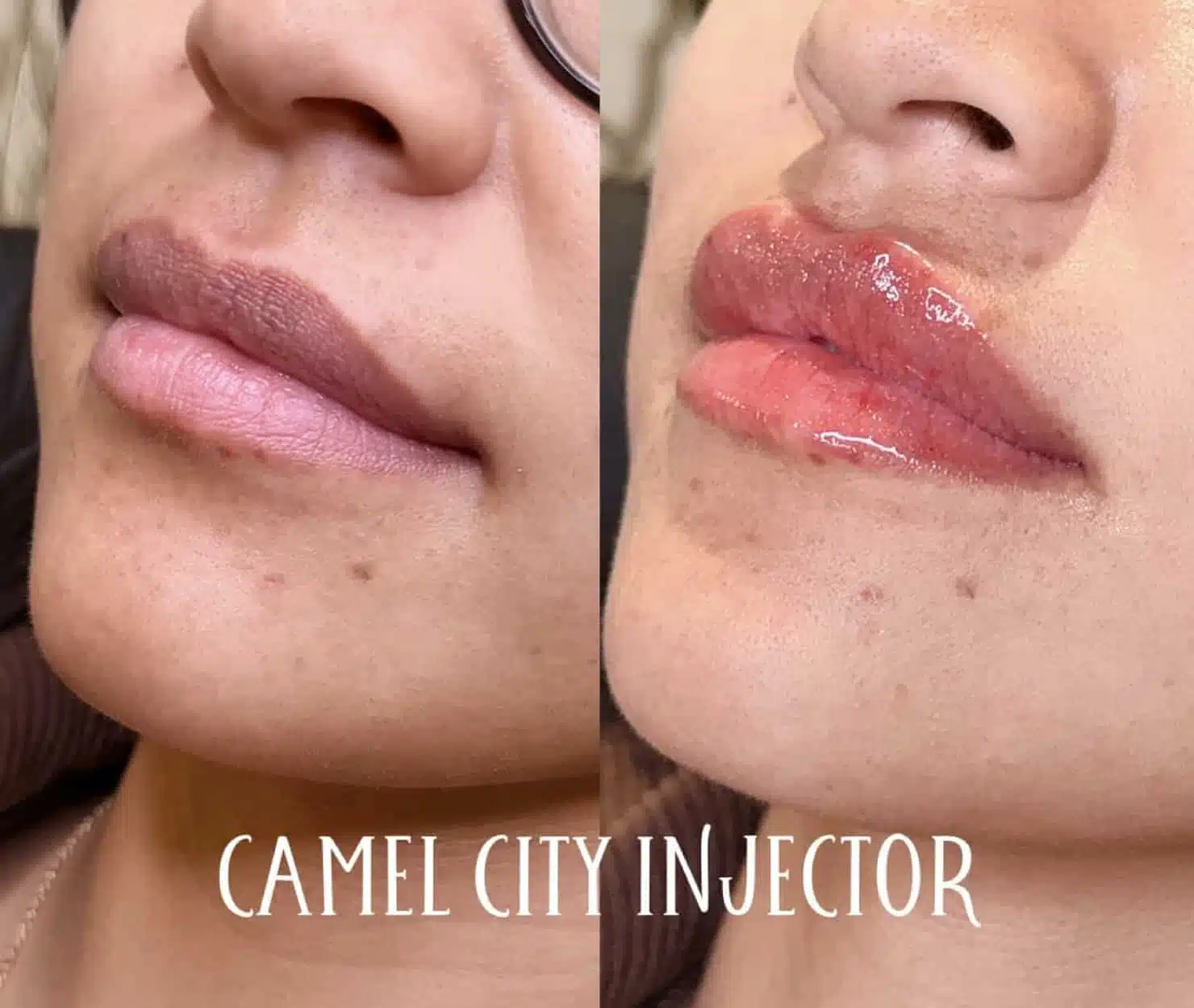 dermal filler designed to redefine