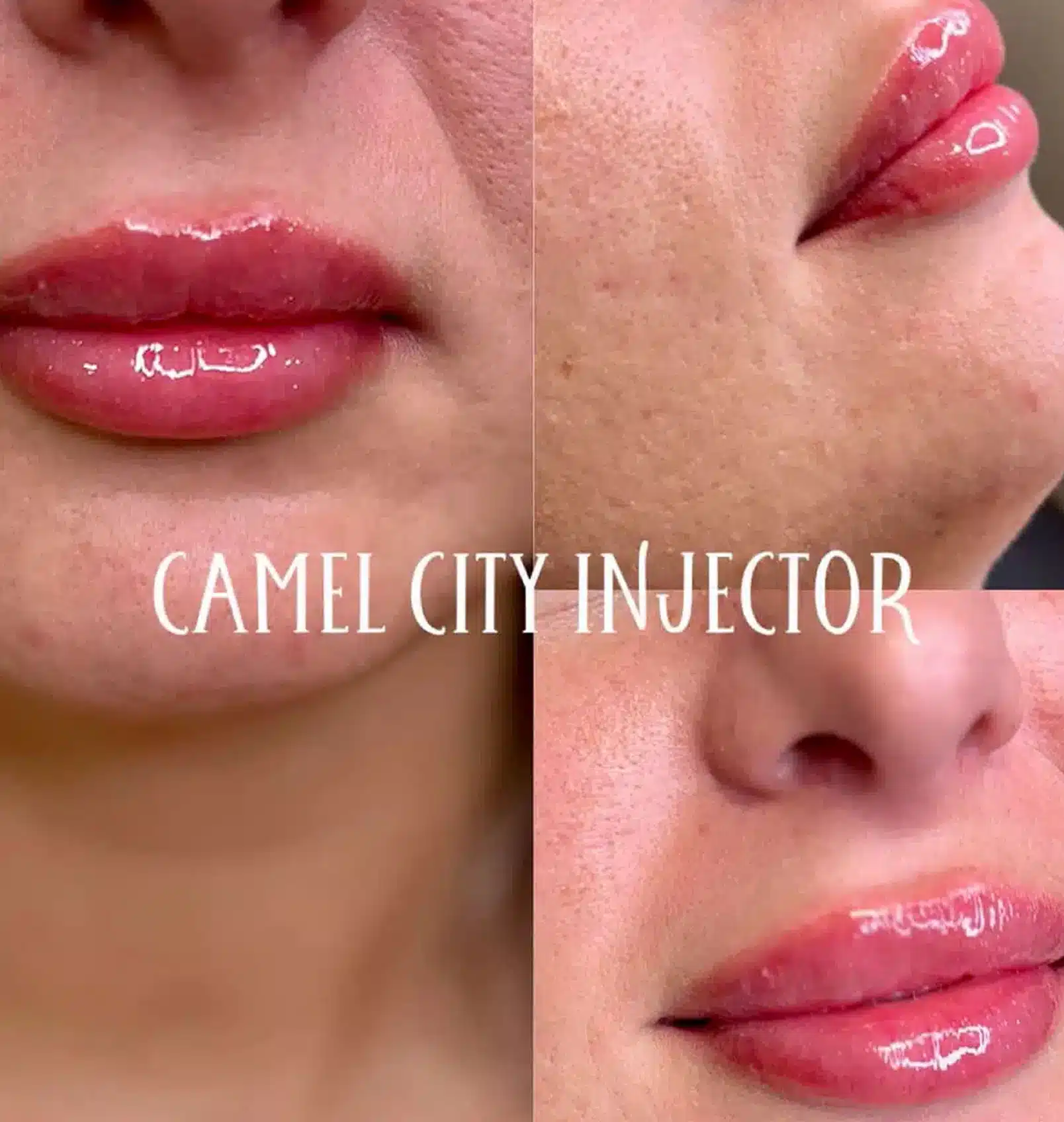 dermal filler designed to redefine