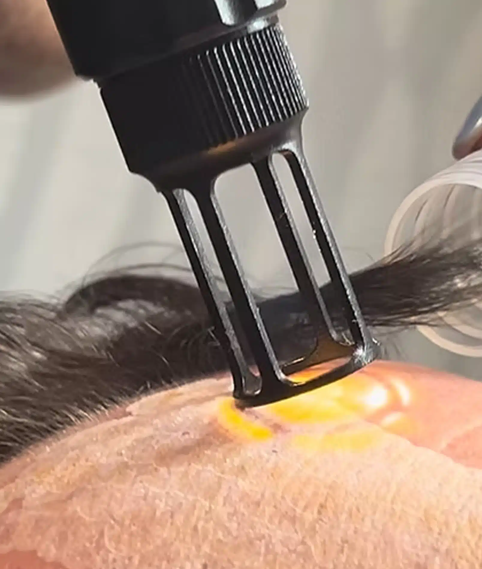 Botox for Every Age