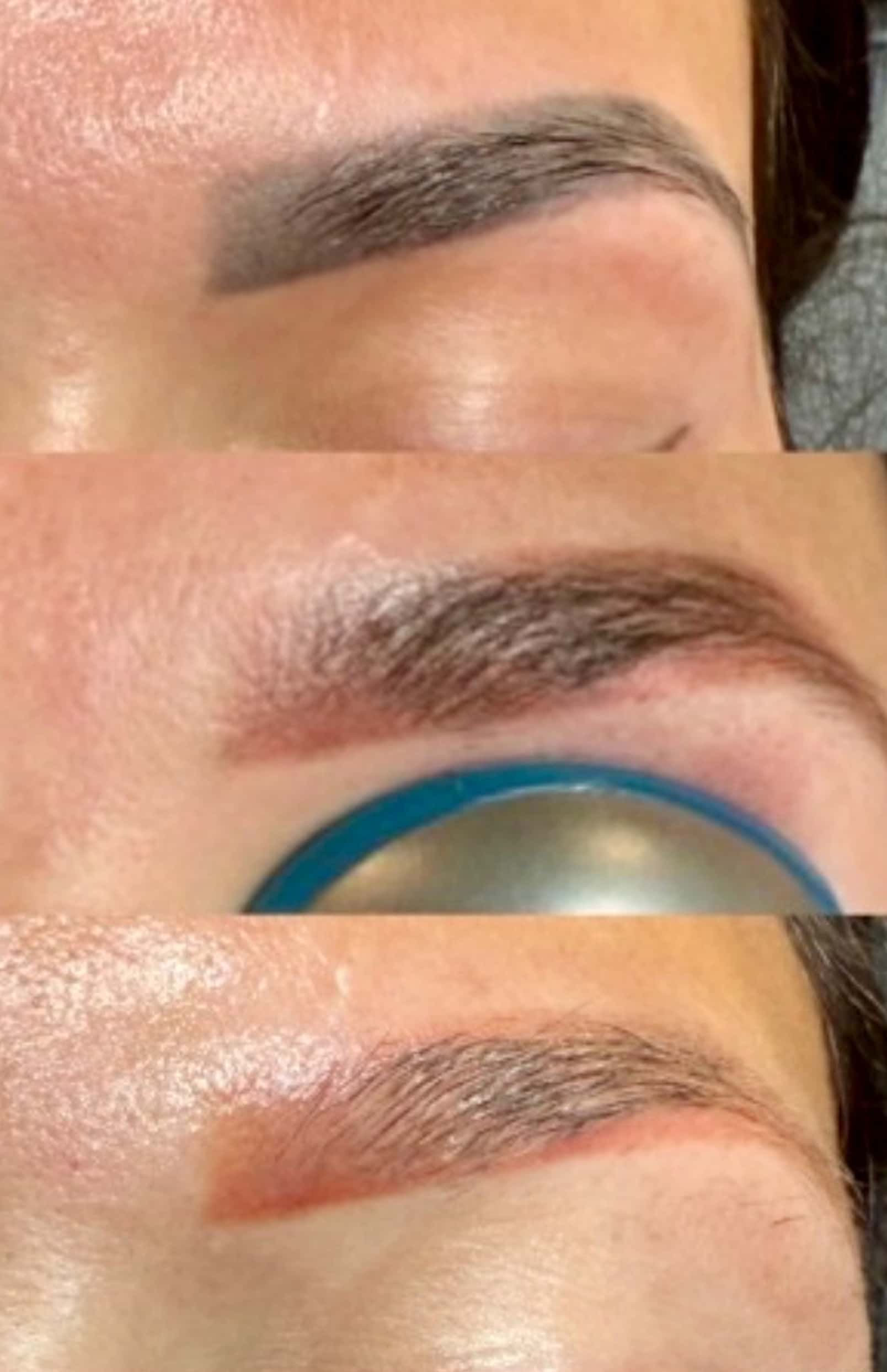 Exploring Modern Solutions for Microblading Removal Daxxify Injections Winston Salem