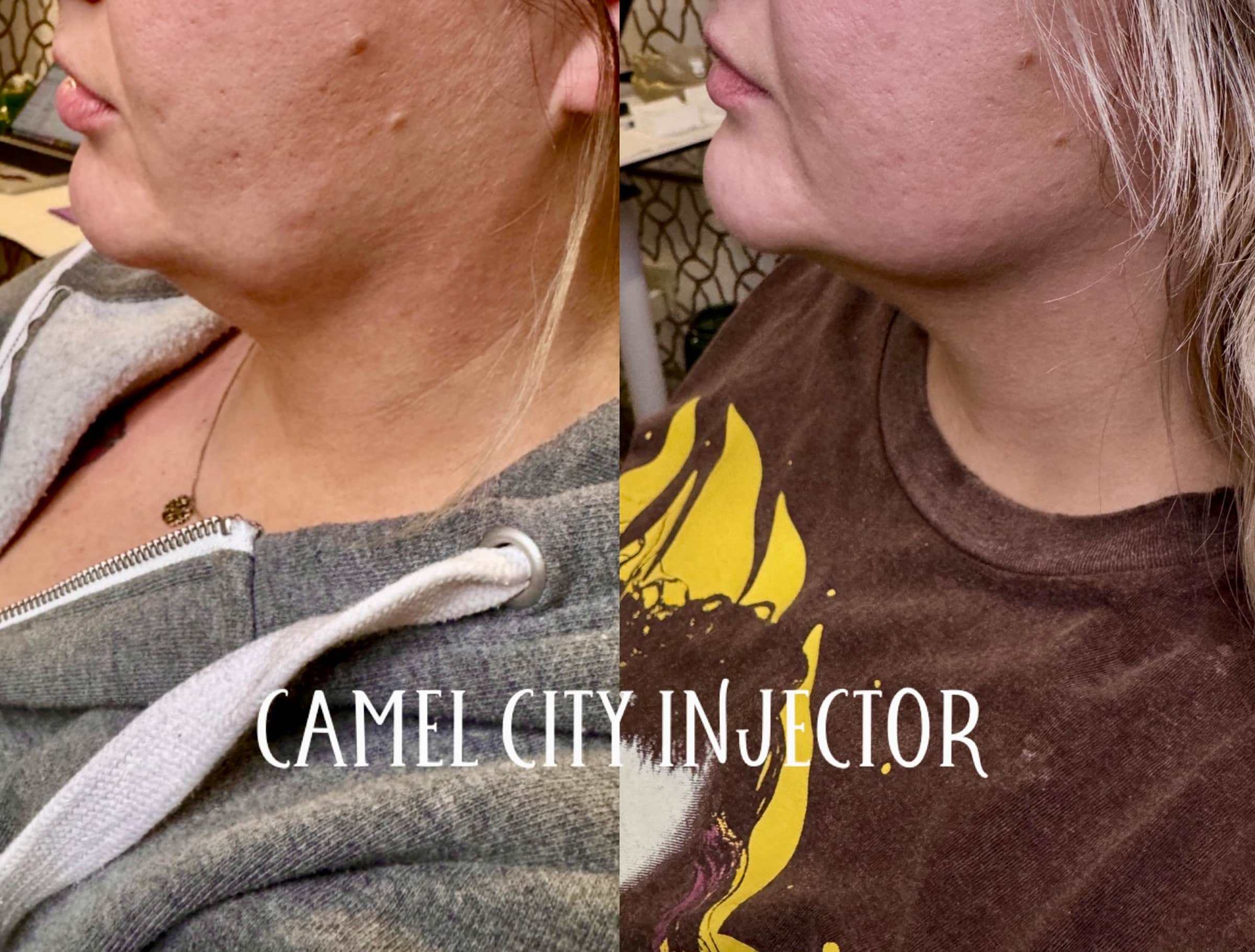 Facial Contours With Cheek Fillers dermal filler designed to redefine