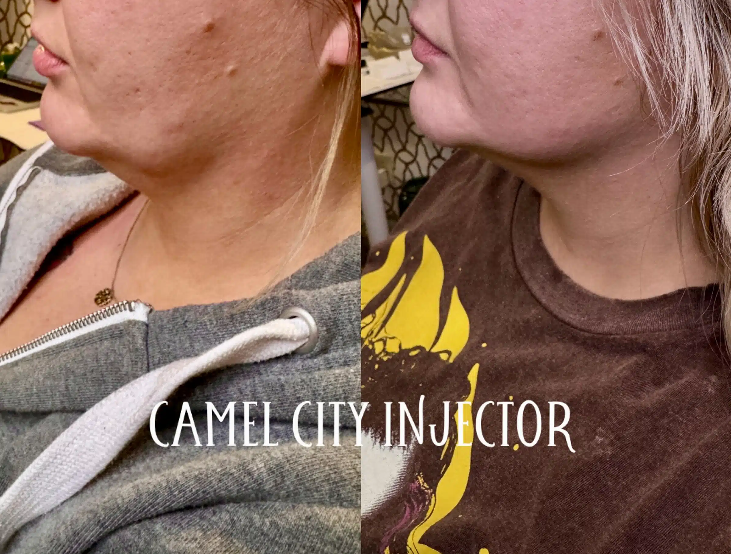 dermal filler designed to redefine