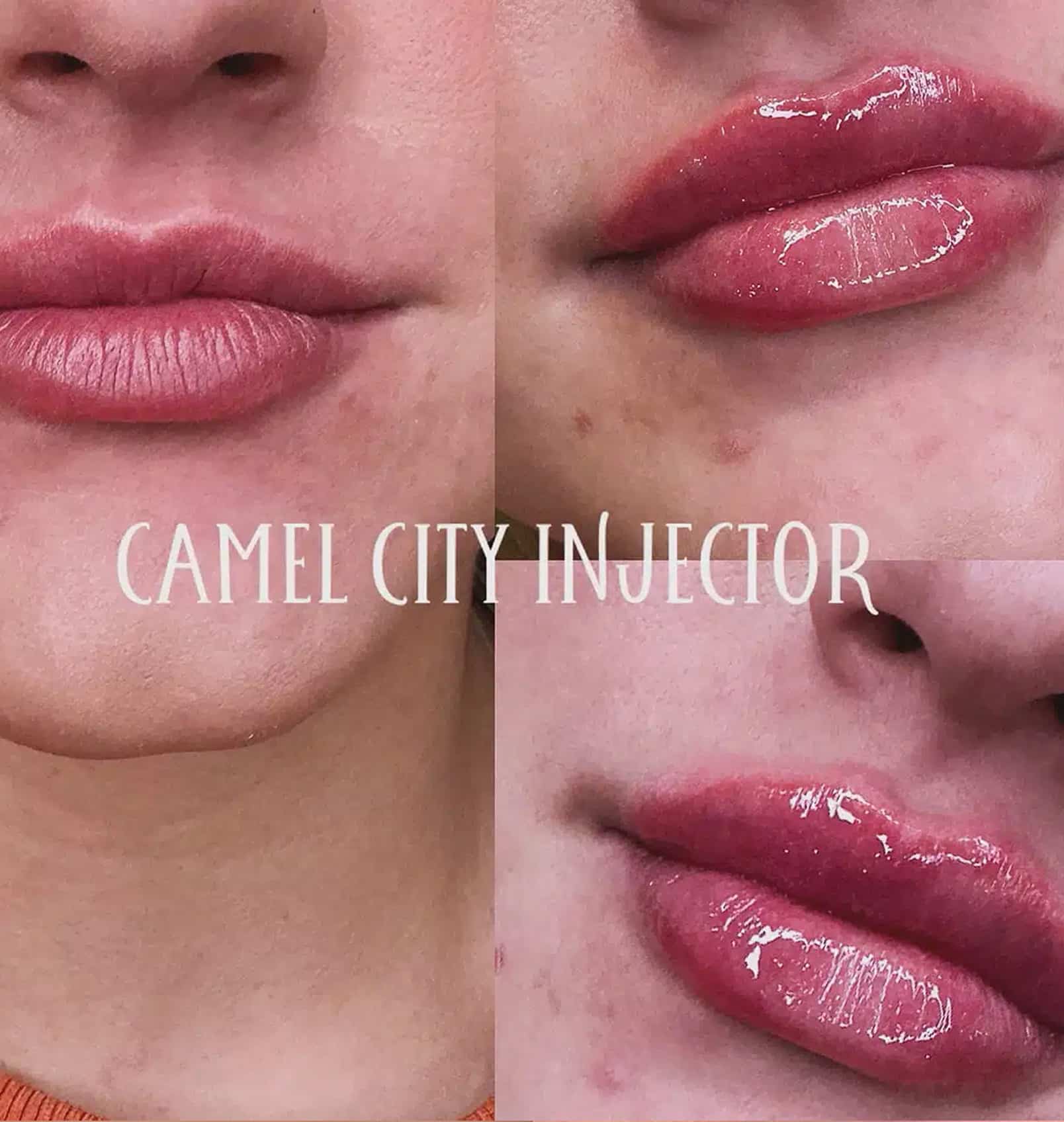 Key Benefits of Professional Cheek Filler Treatments dermal filler designed to redefine