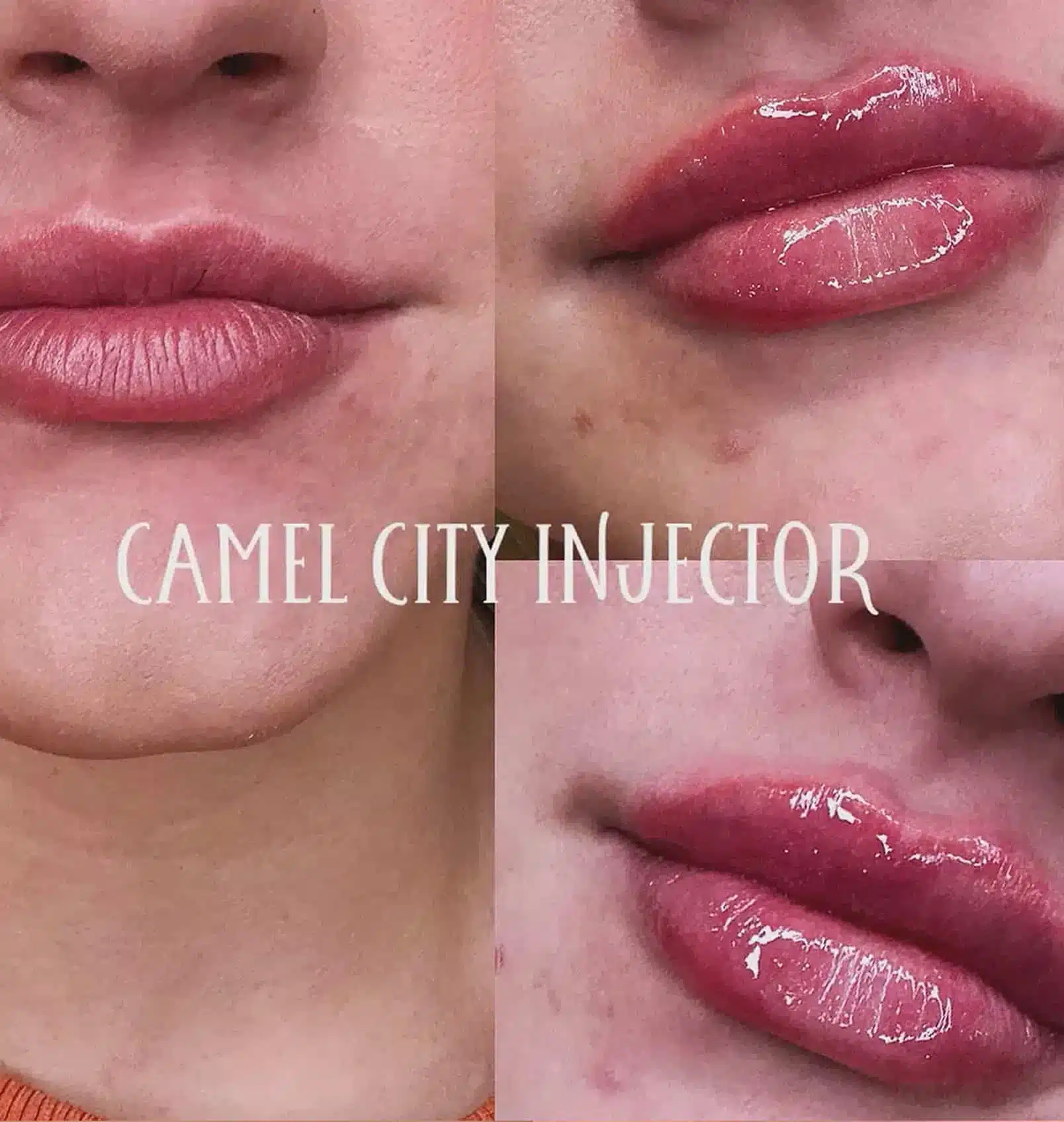 dermal filler designed to redefine