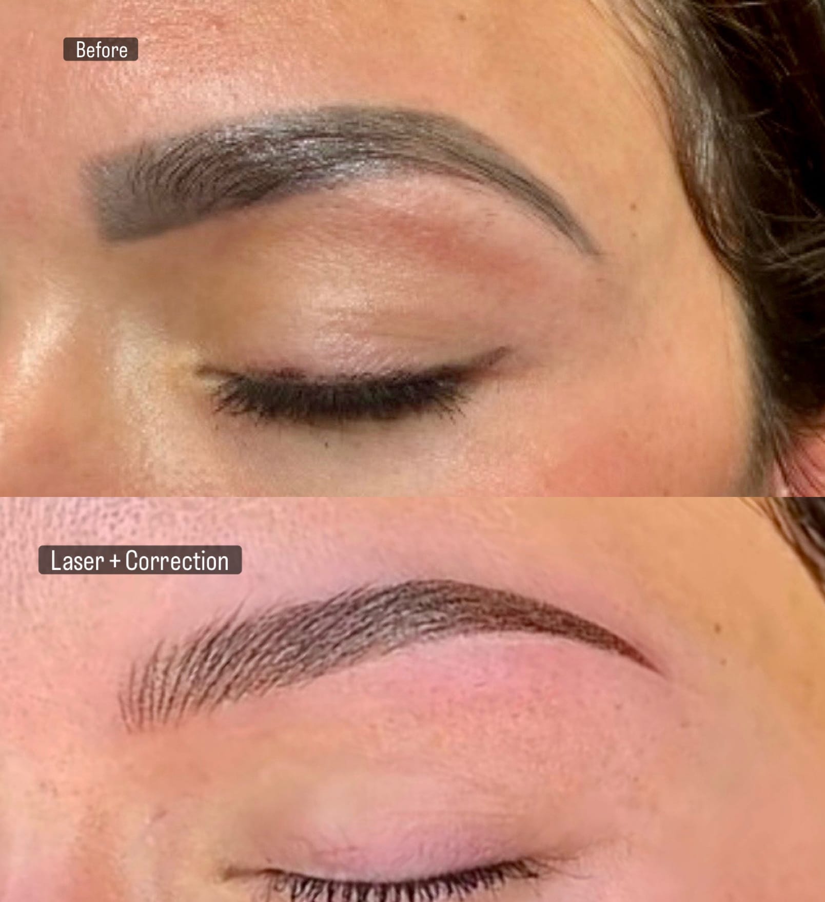 Laser-Based Microblading Removal Benefit from a Thread Lift