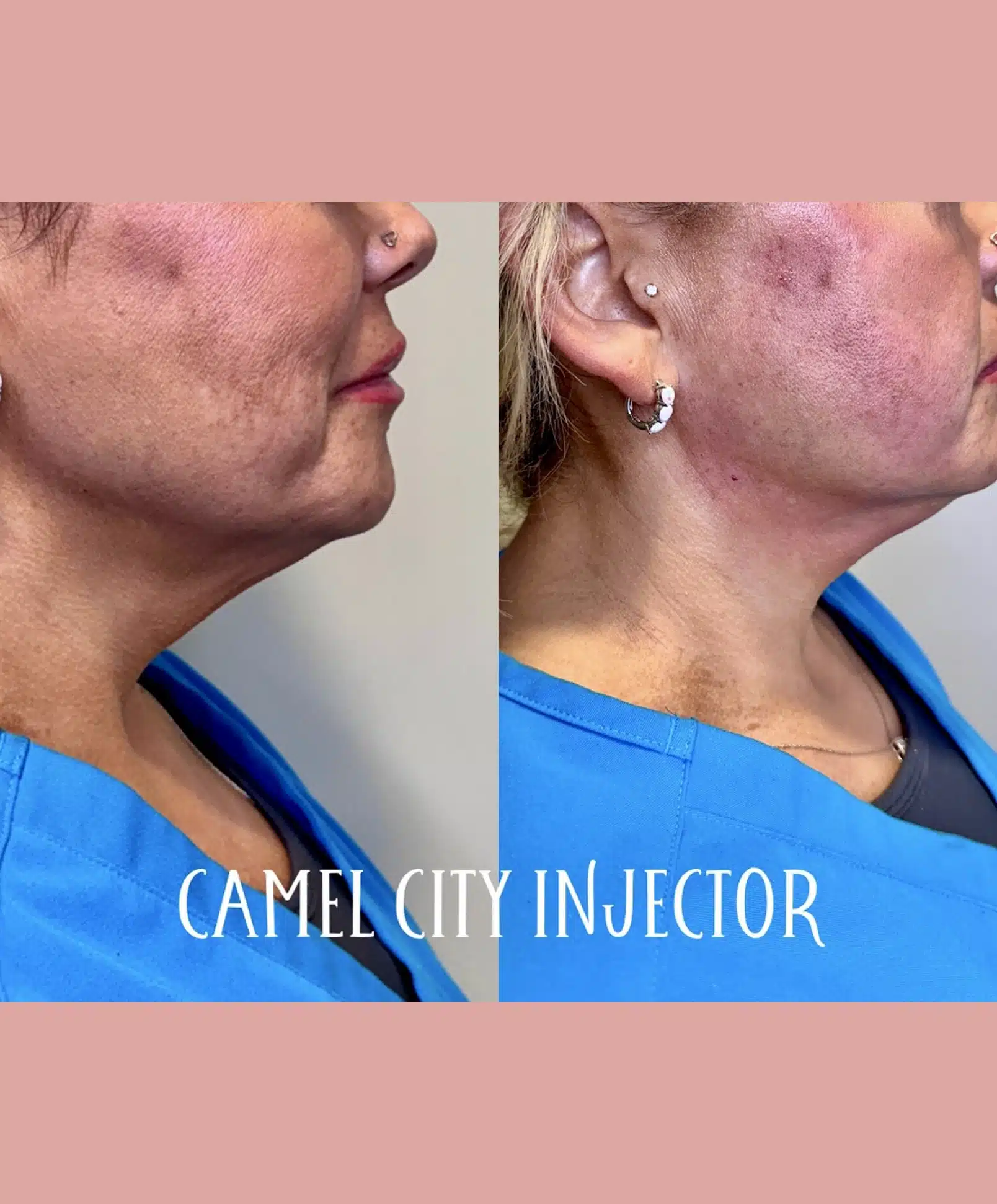 Key Facial Areas That Benefit From Botox