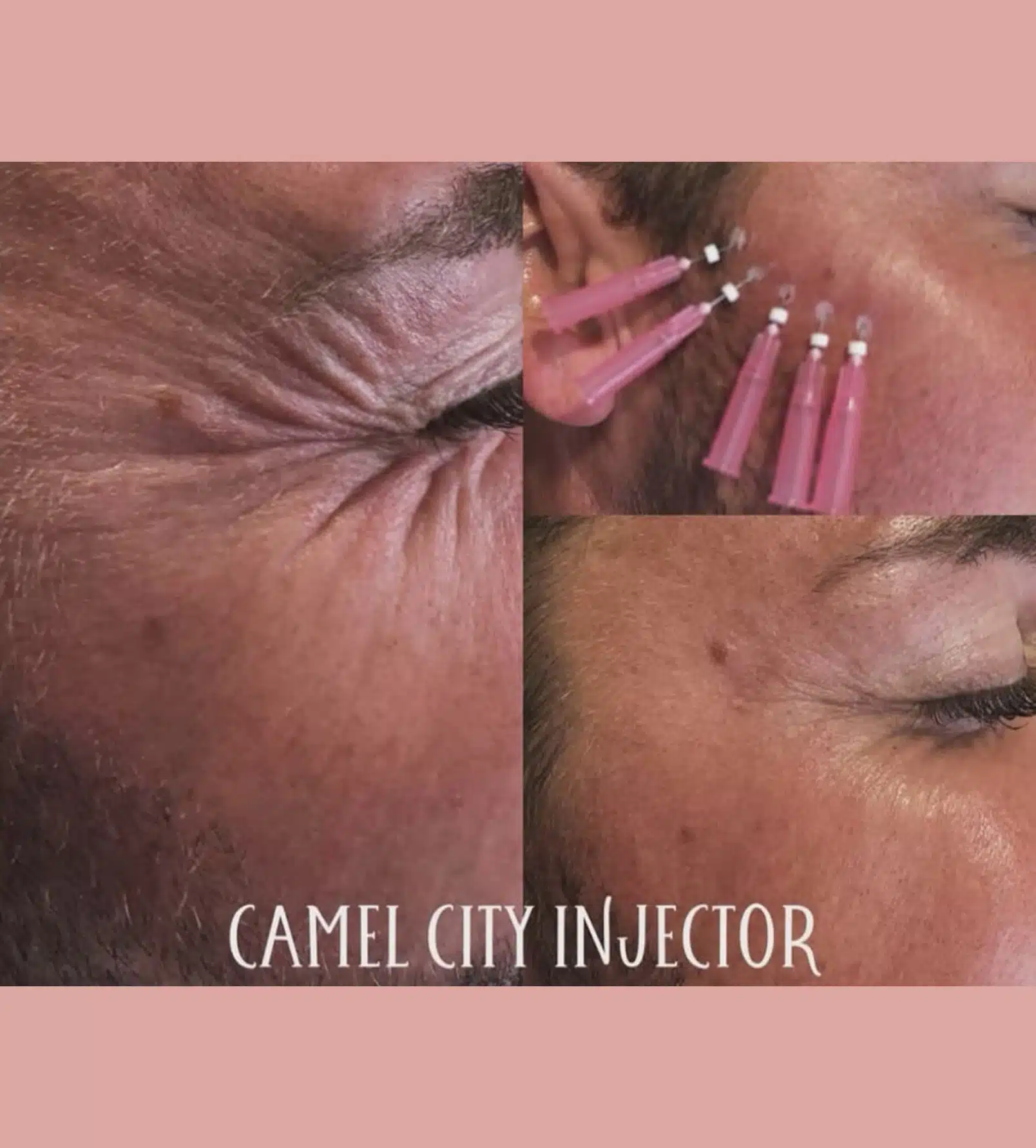 Eye Filler to Other Options
