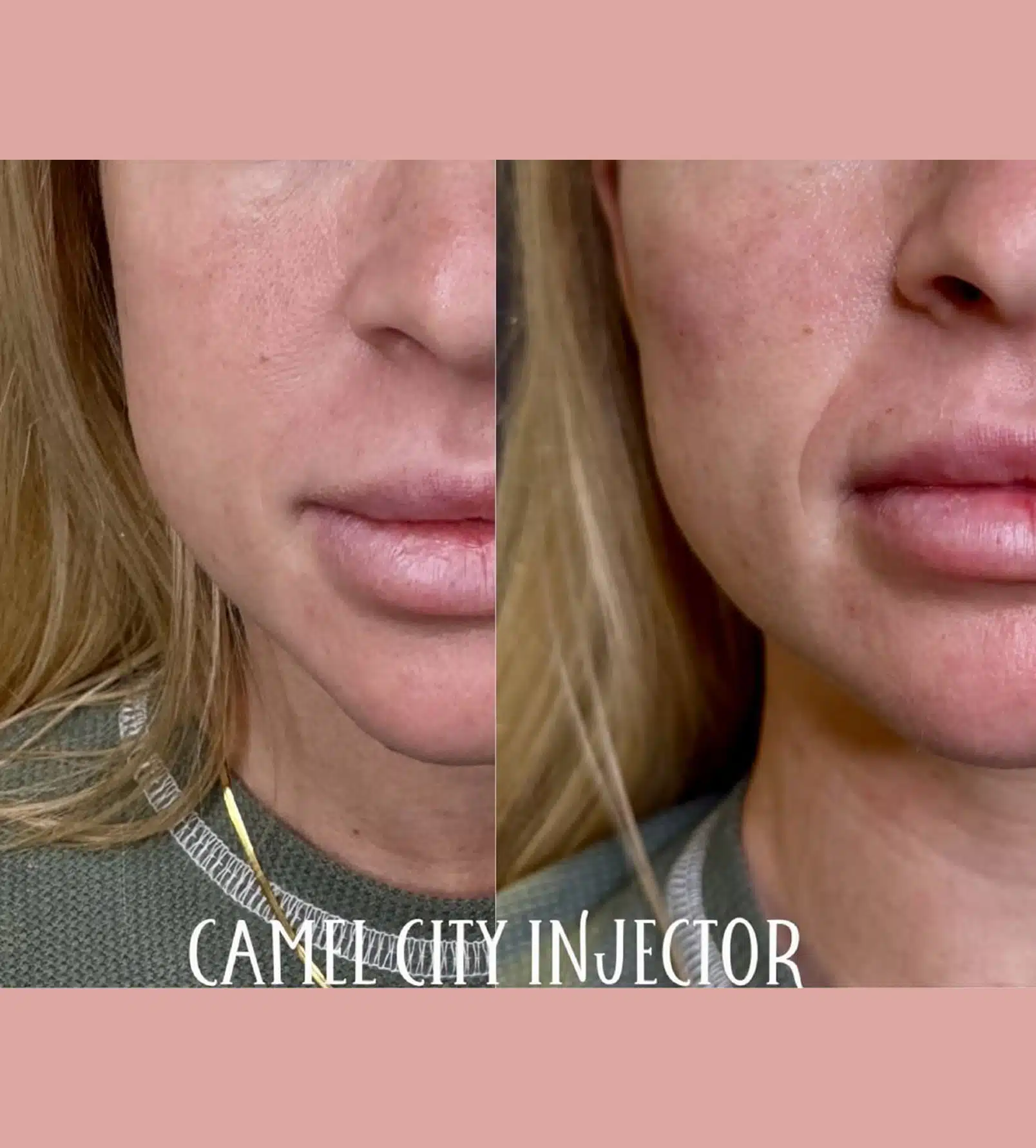 Key Facial Areas That Benefit From Botox