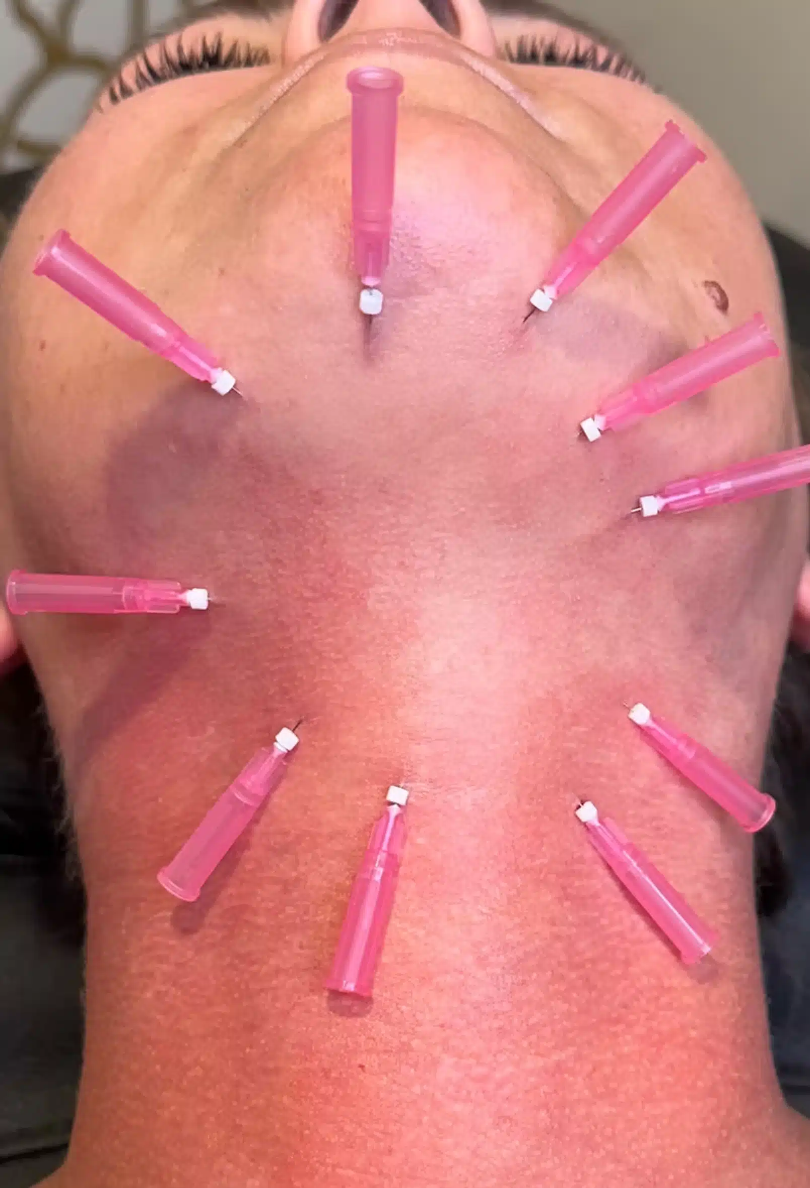 Daxxify Injections Winston Salem