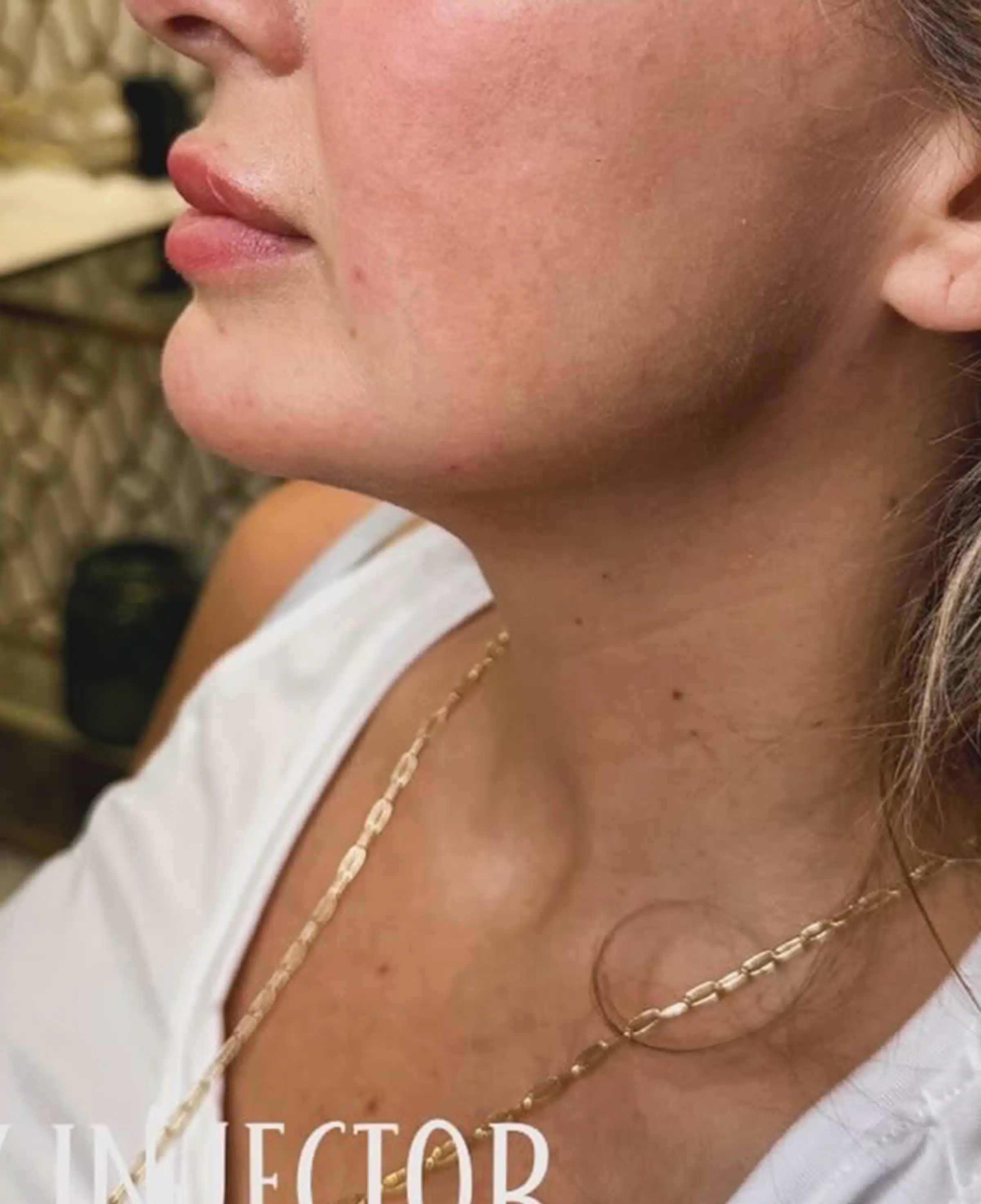 dermal filler designed to redefine