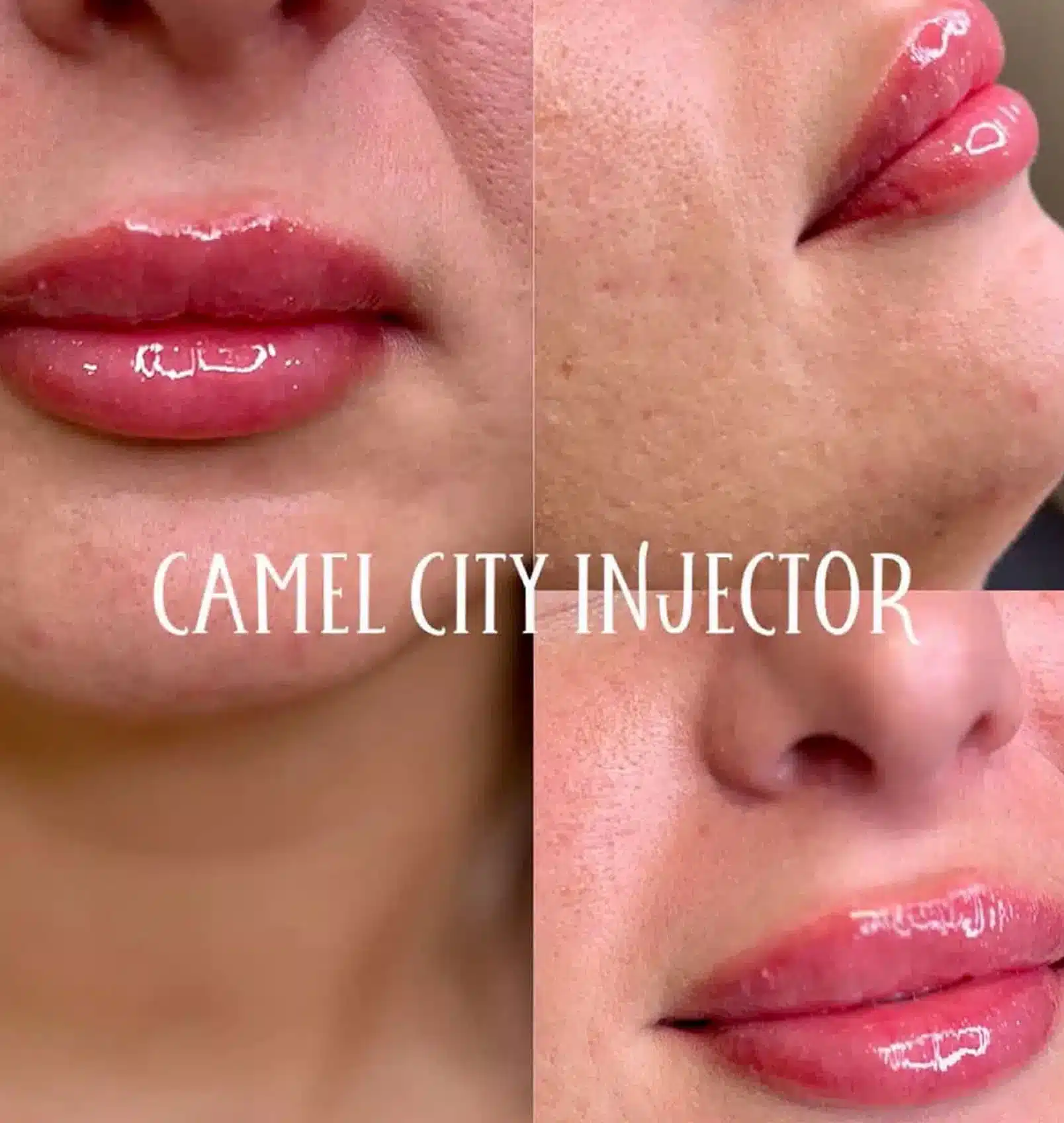 dermal filler designed to redefine