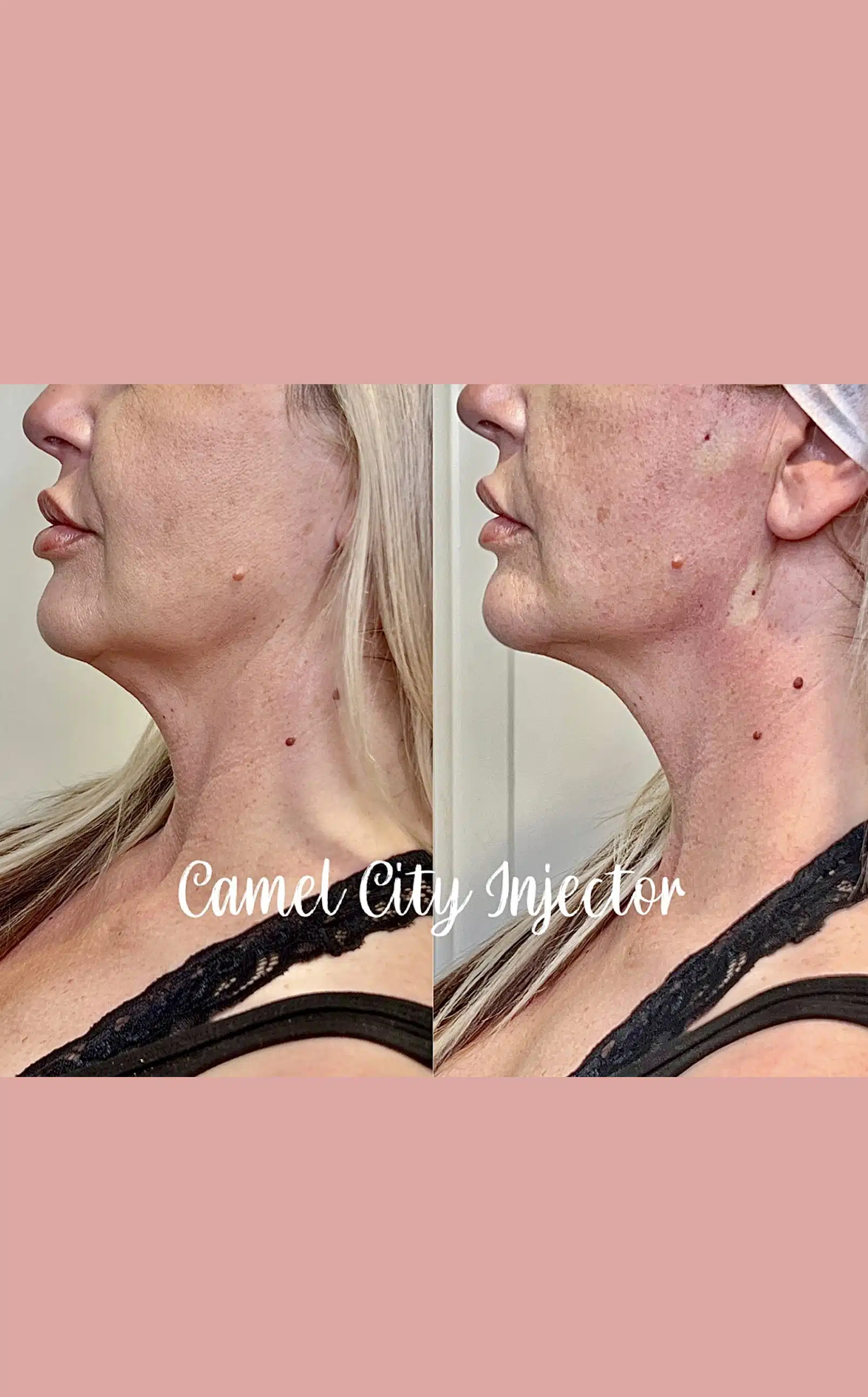 Botox for Every Age