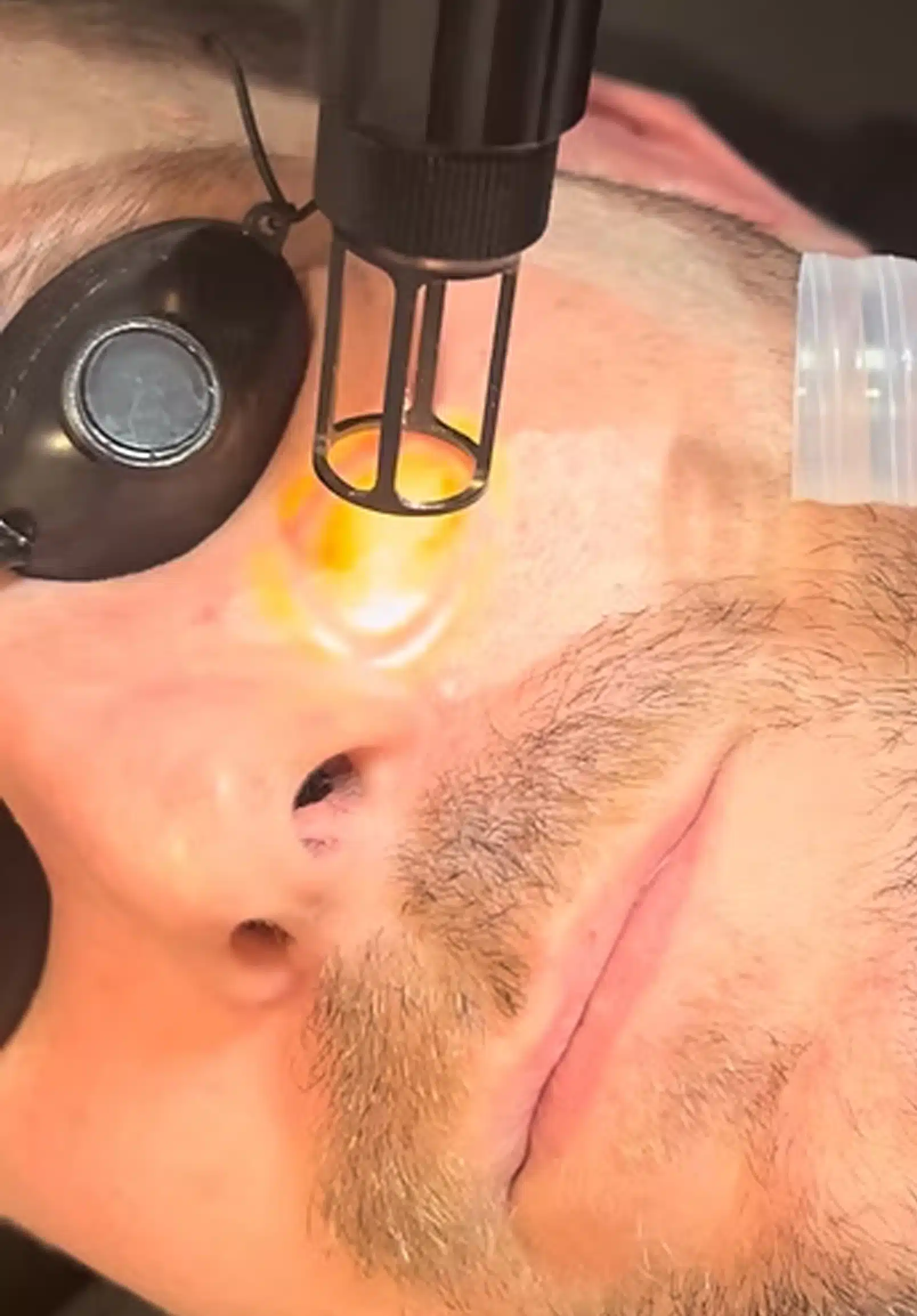 Eye Filler to Other Options