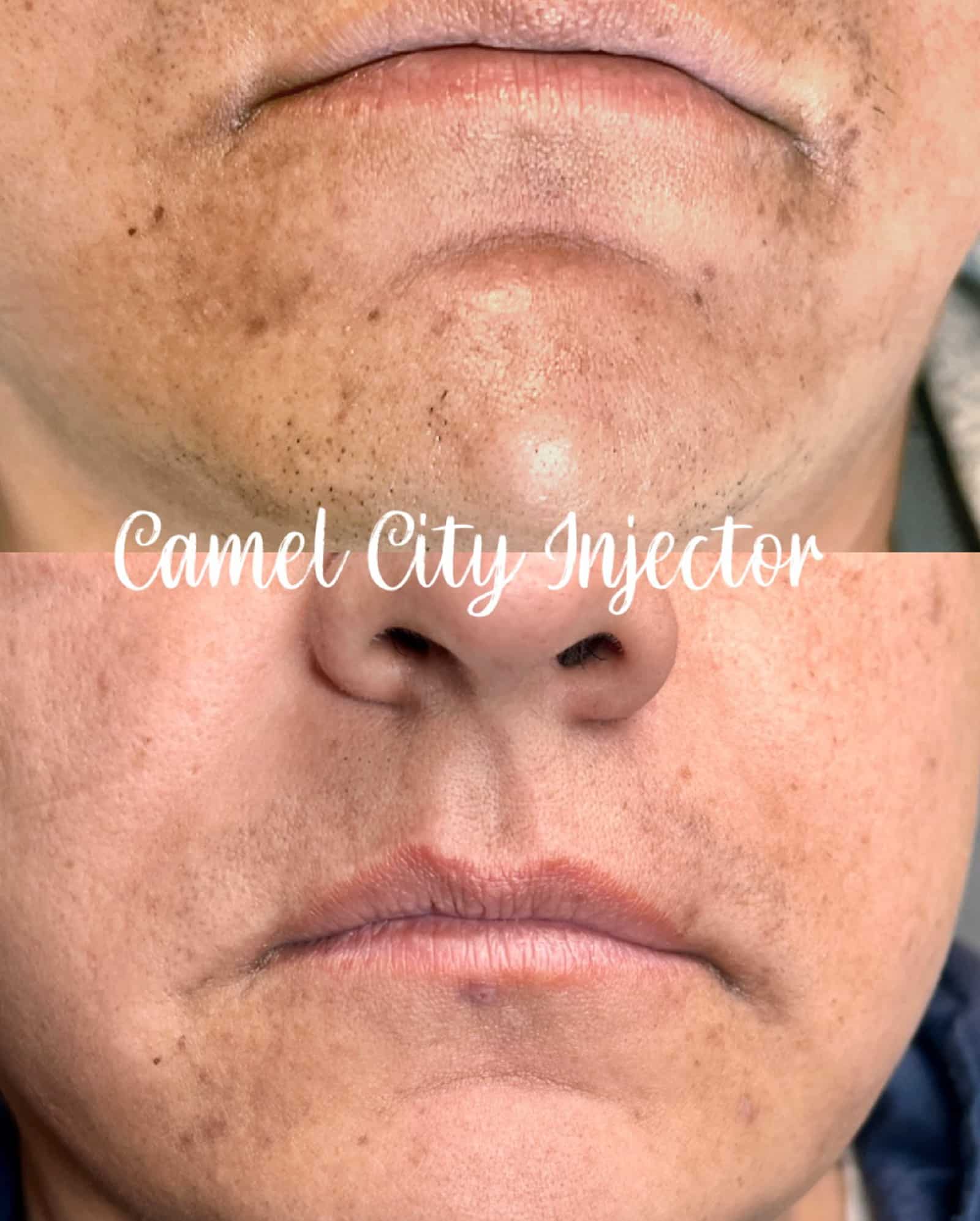chemical peel Trusted Choice in NC recovery Tips and Post-Treatment Care
