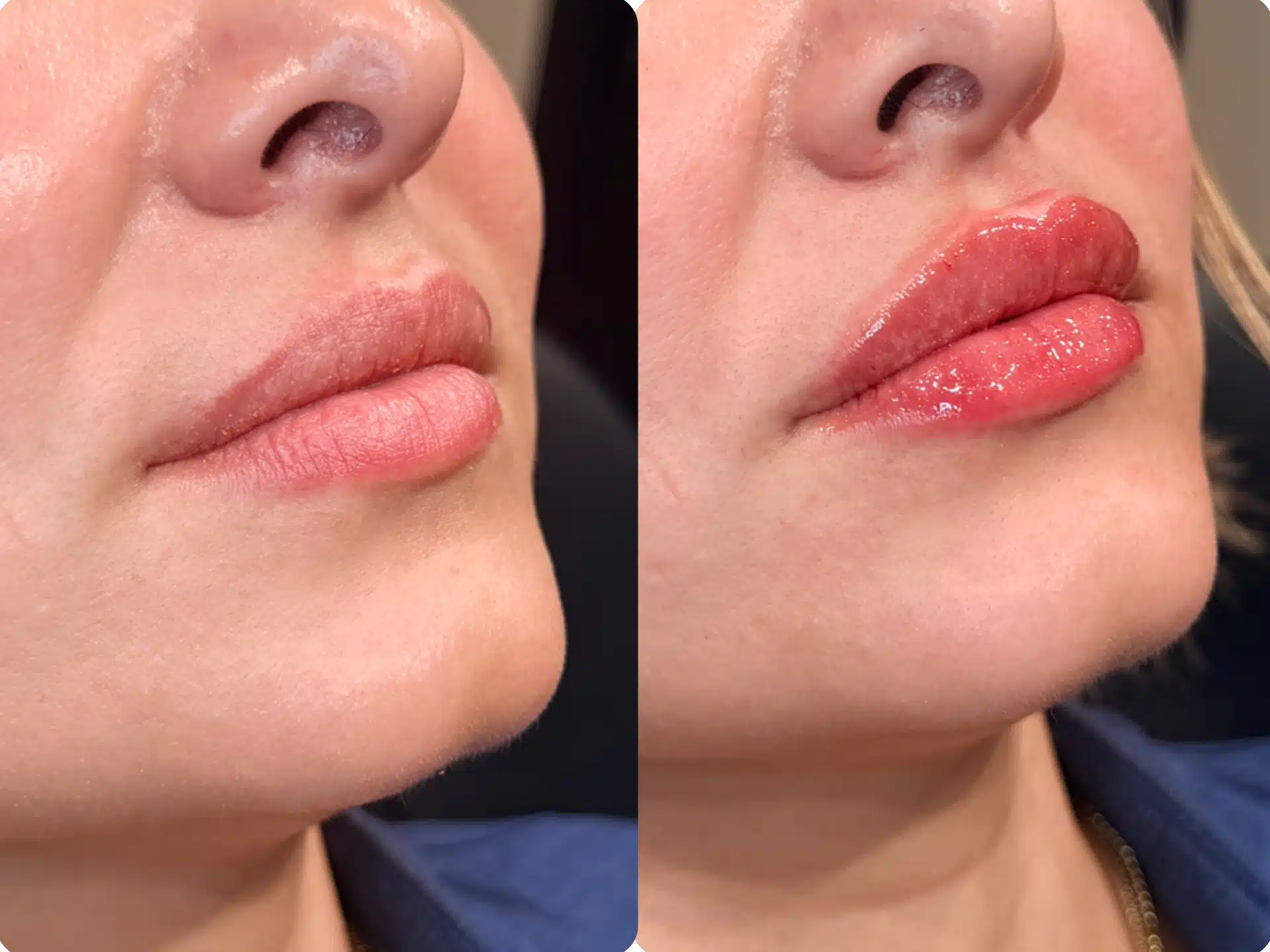 restylane lip filler winston salem restylane lip filler winston salem