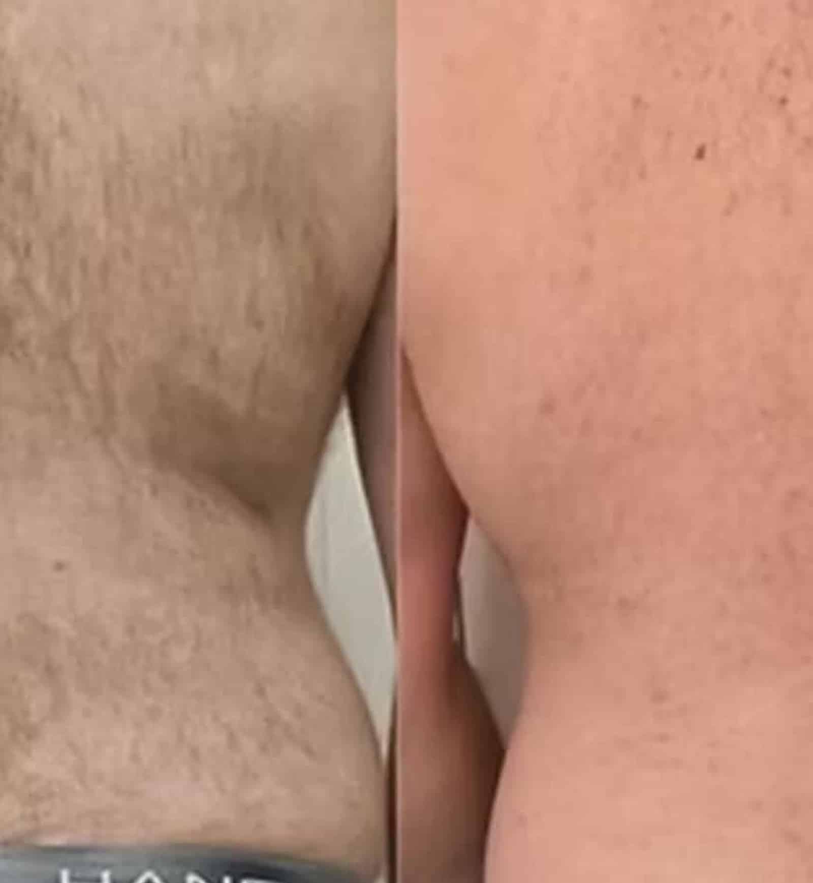 Laser Hair Removal Professional Laser Treatments Choosing Professional Laser Treatments