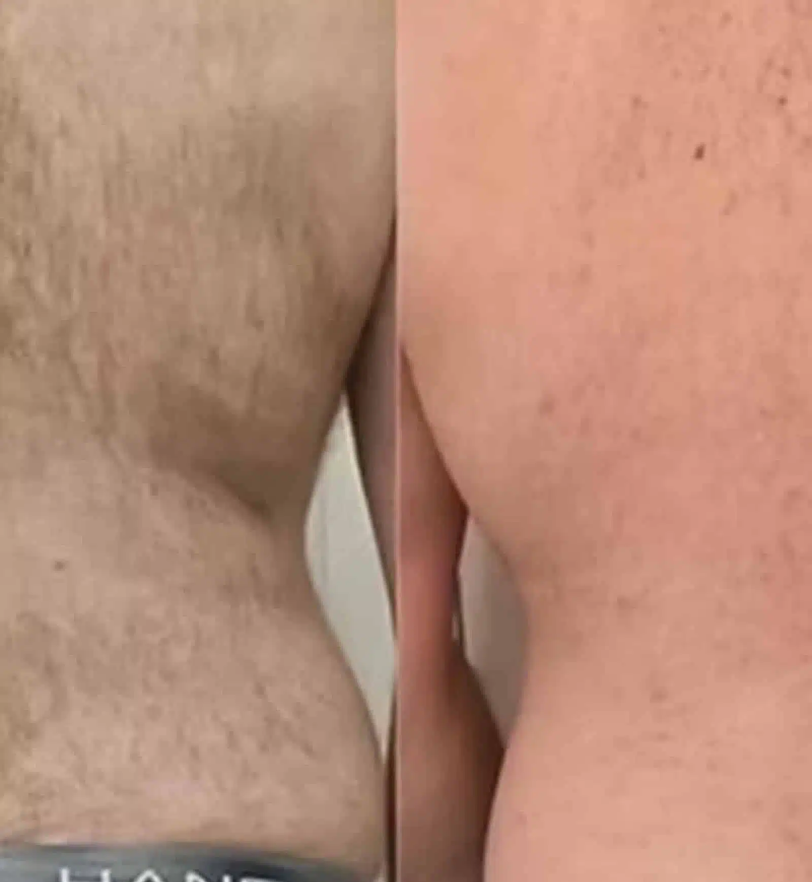 Choosing Professional Laser Treatments