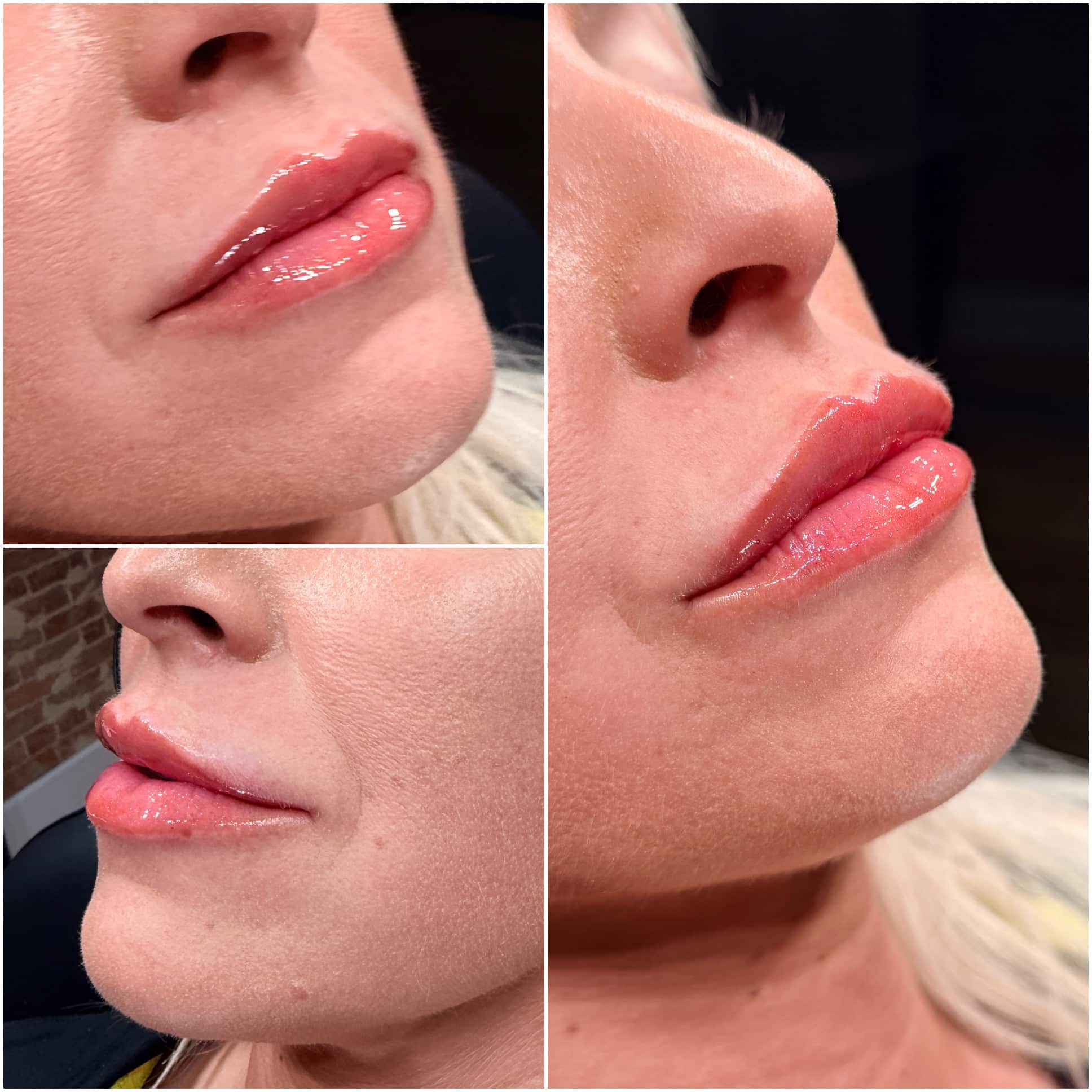lip filler winston salem lip filler winston salem