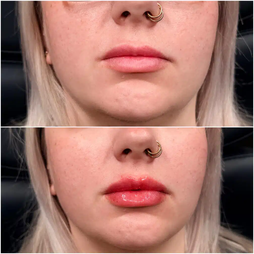 Lip and upper teeth area at Camel City Injector