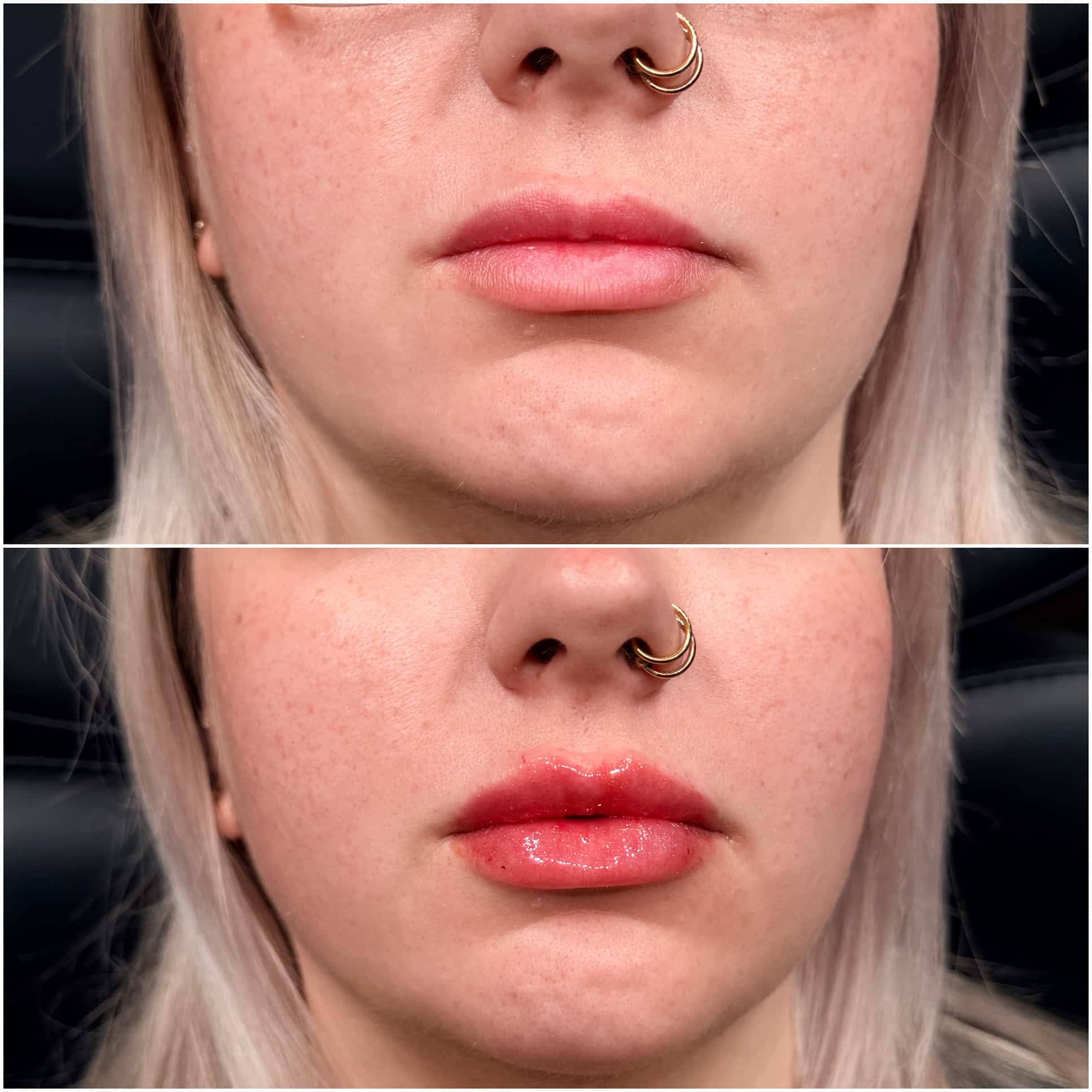 lip filler winston salem lip filler winston salem
