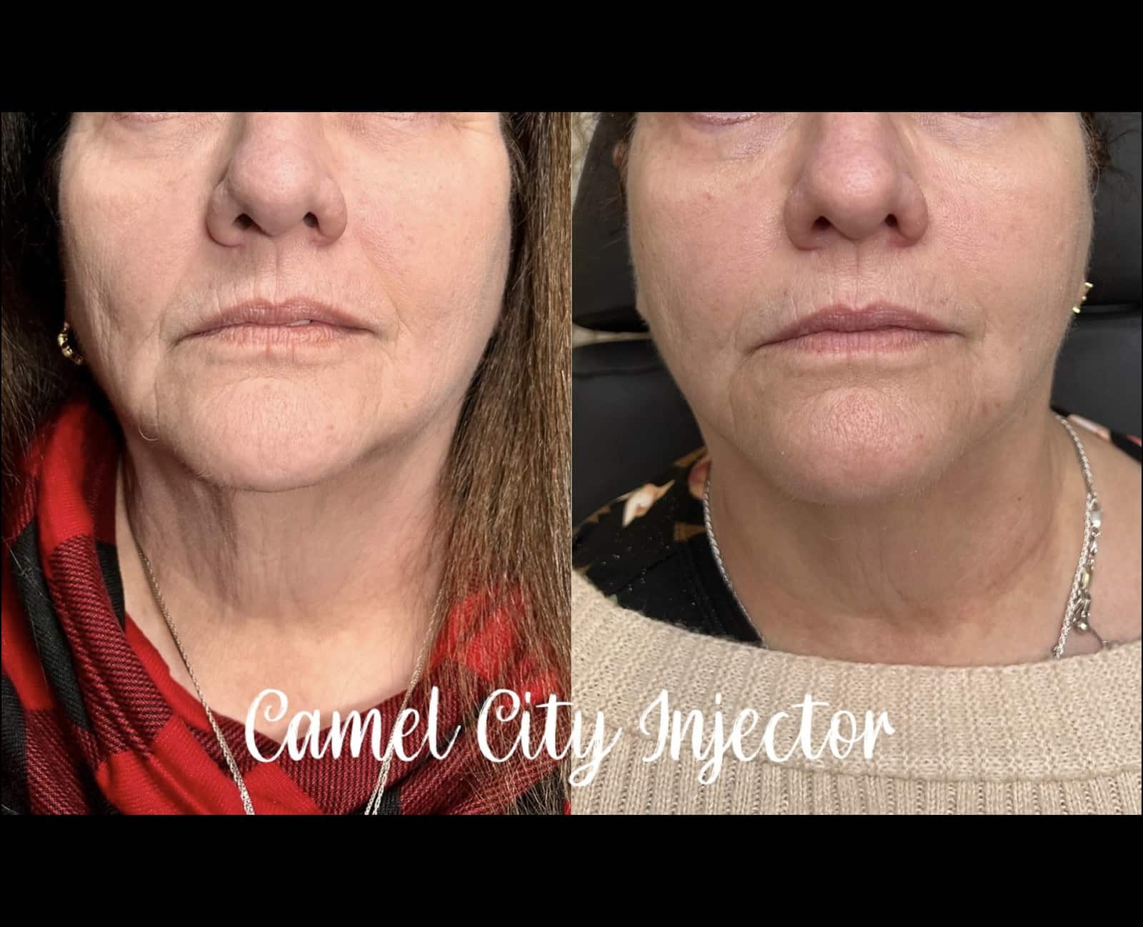 Subtle tightening Botox for Every Age